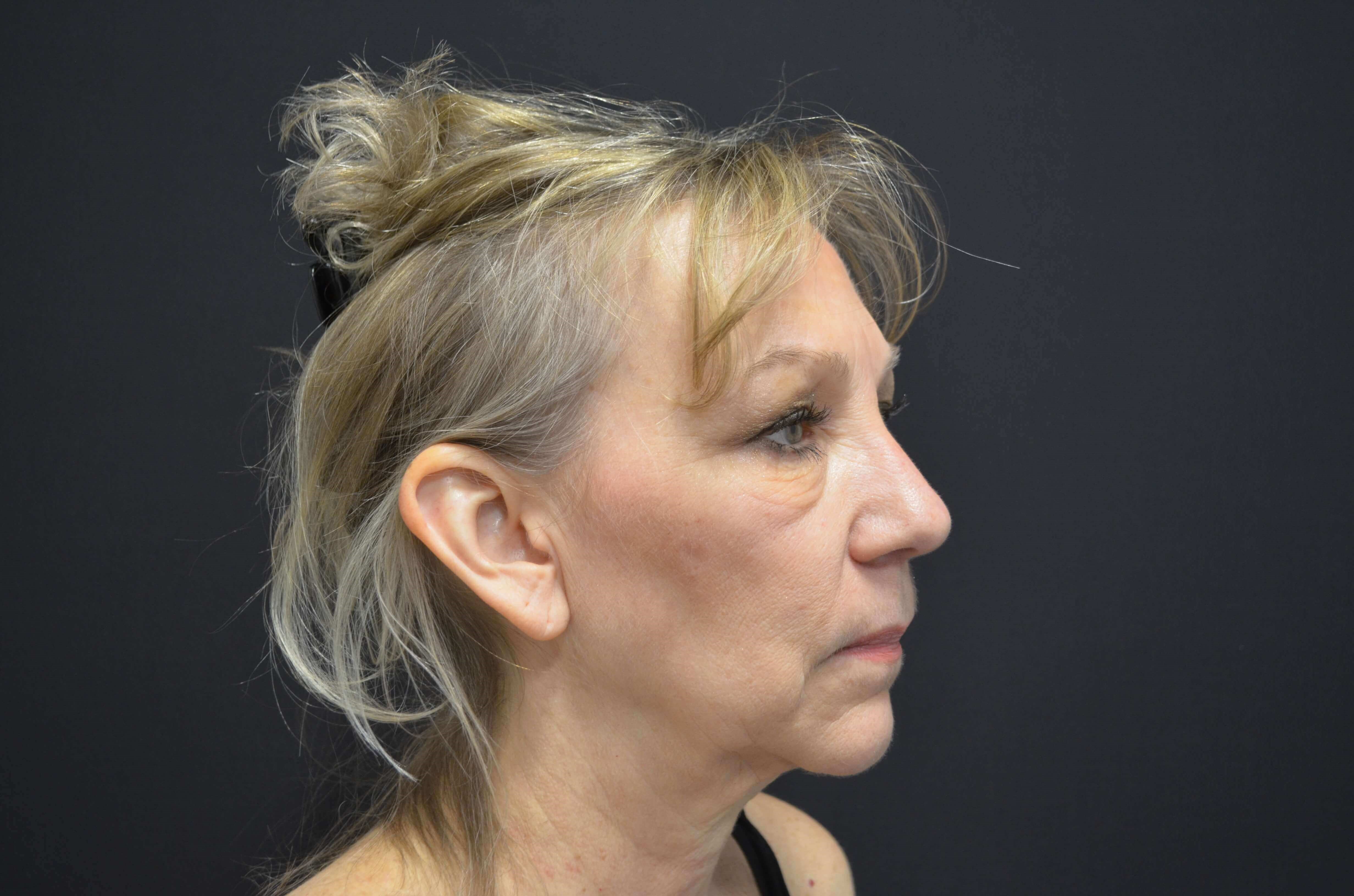 Natural Lower Face & Neck Lift Before