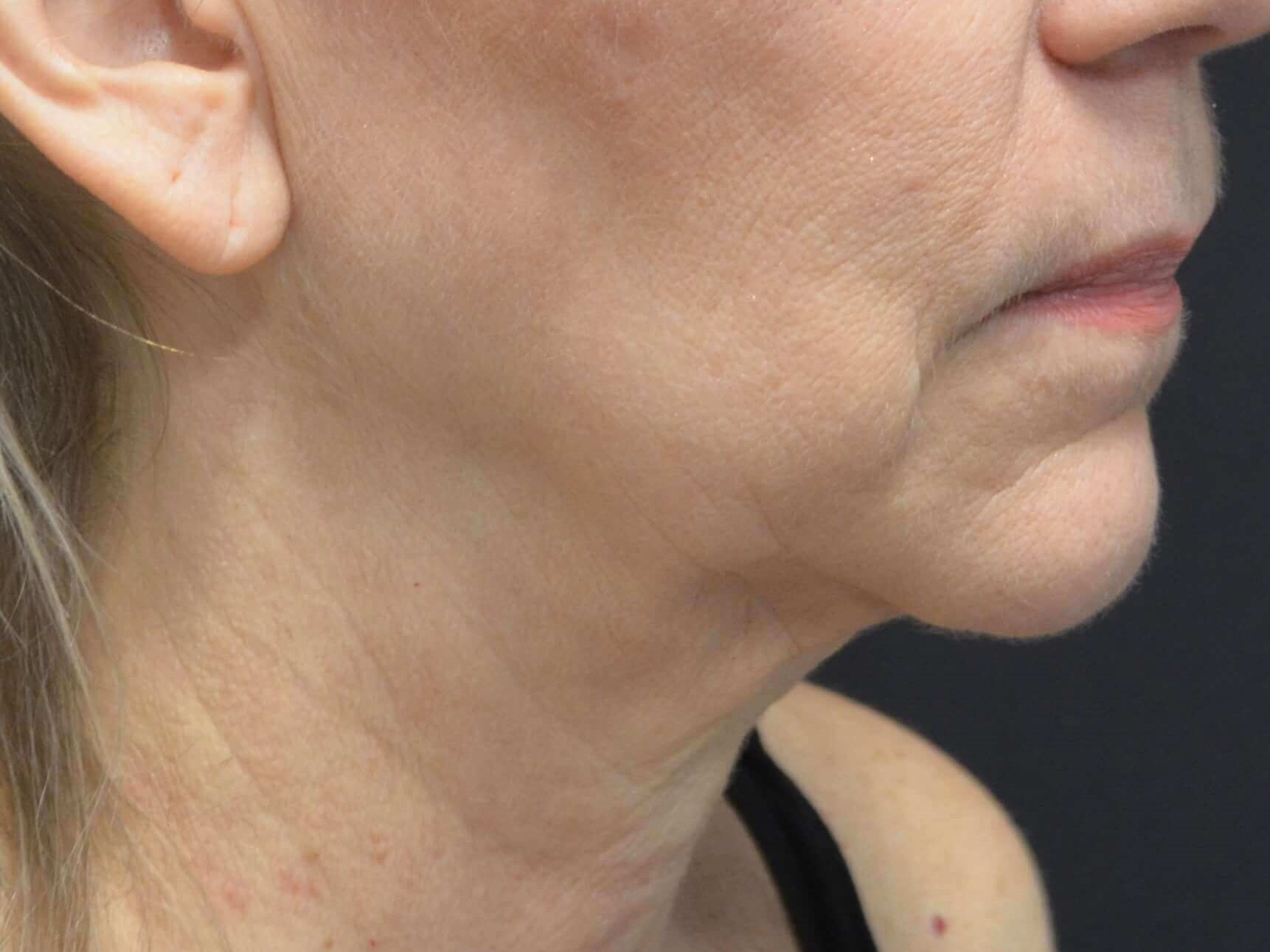 Natural Lower Face & Neck Lift Before