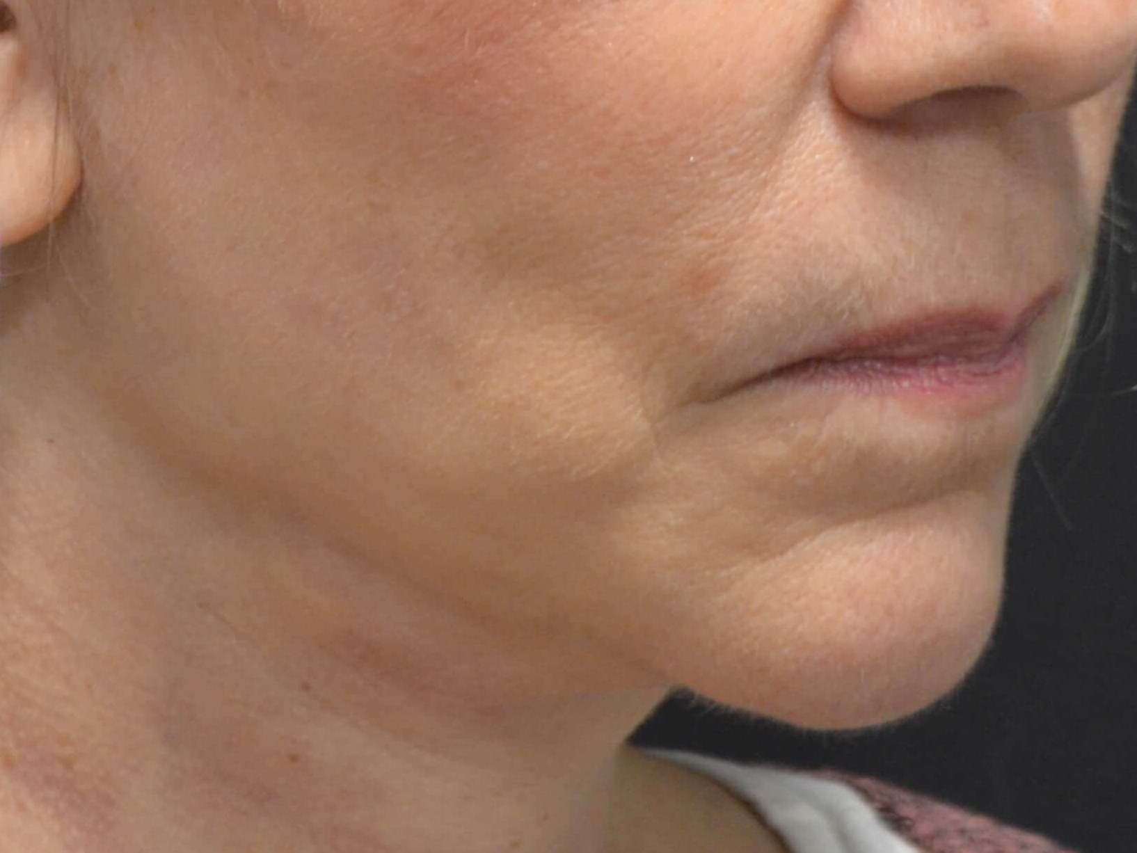Natural Lower Face & Neck Lift After