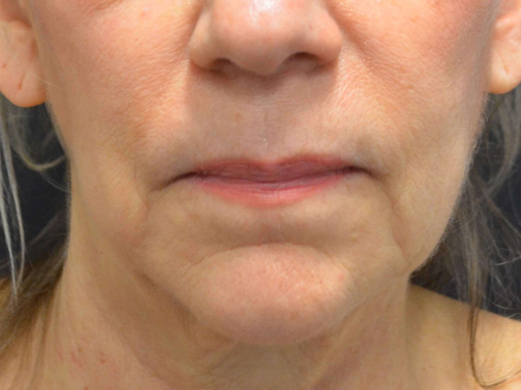 Natural Lower Face & Neck Lift Before