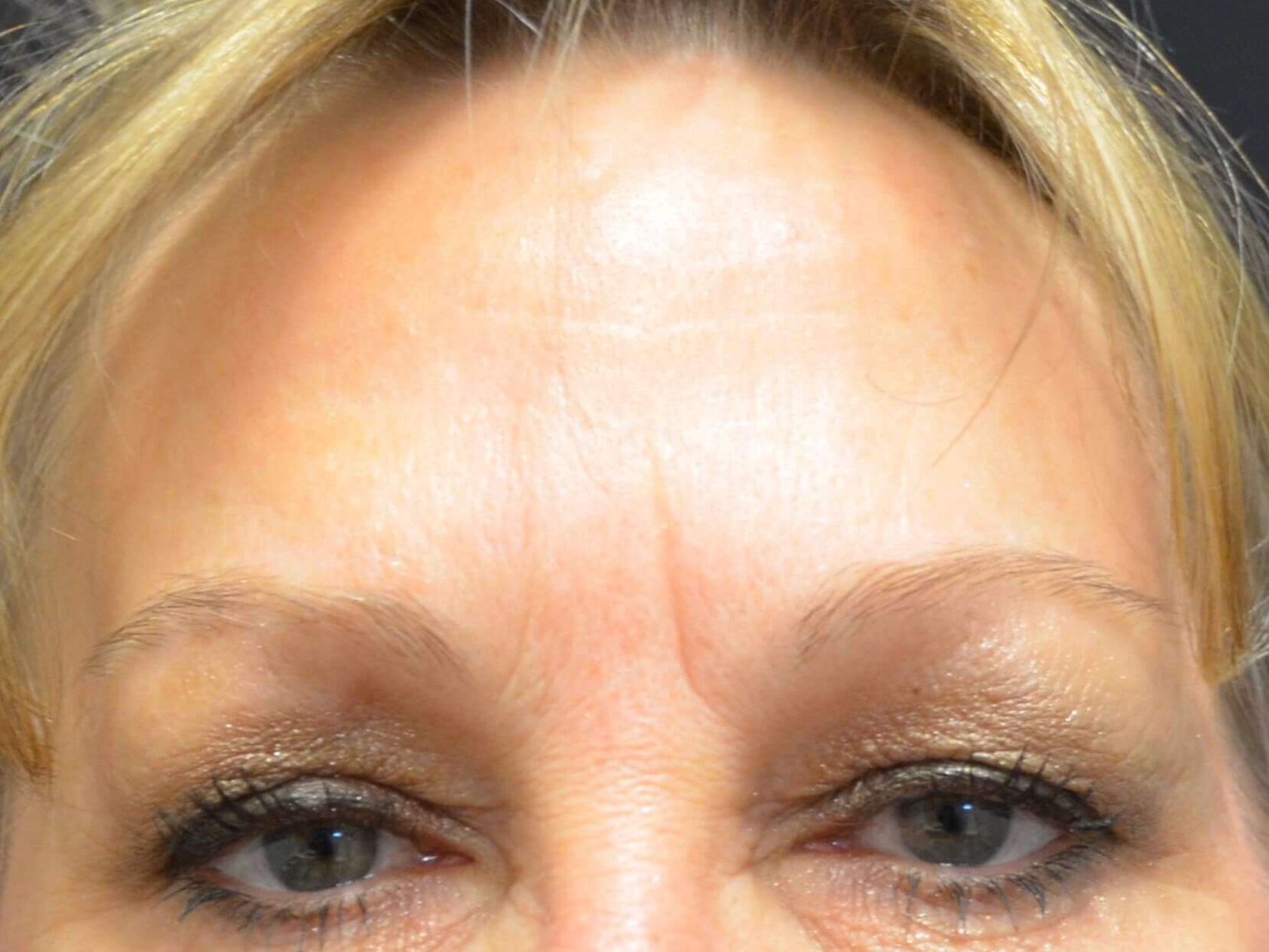 Brow Lift & Upper Eyelid Lift Before