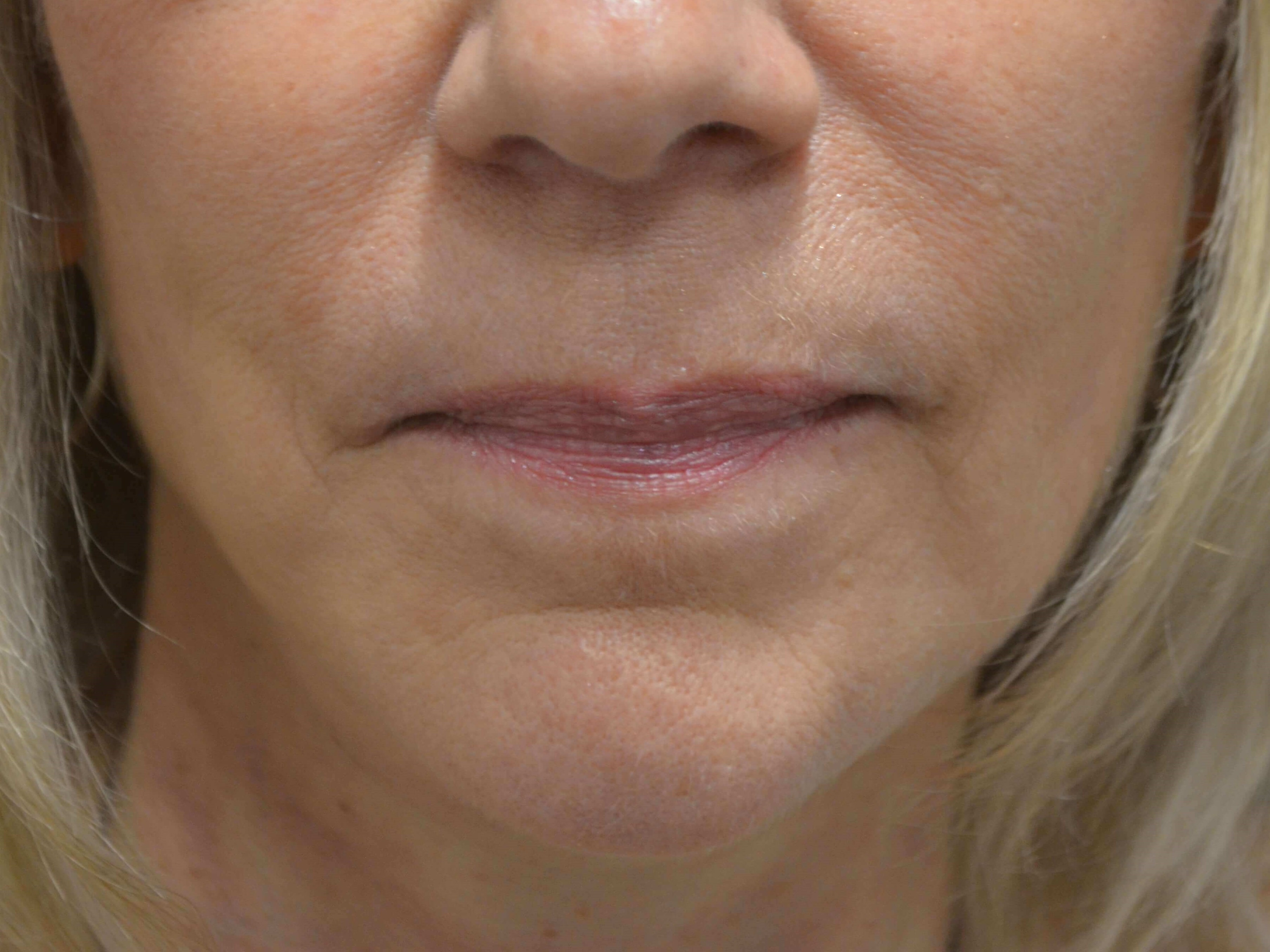 Natural Lower Face & Neck Lift After