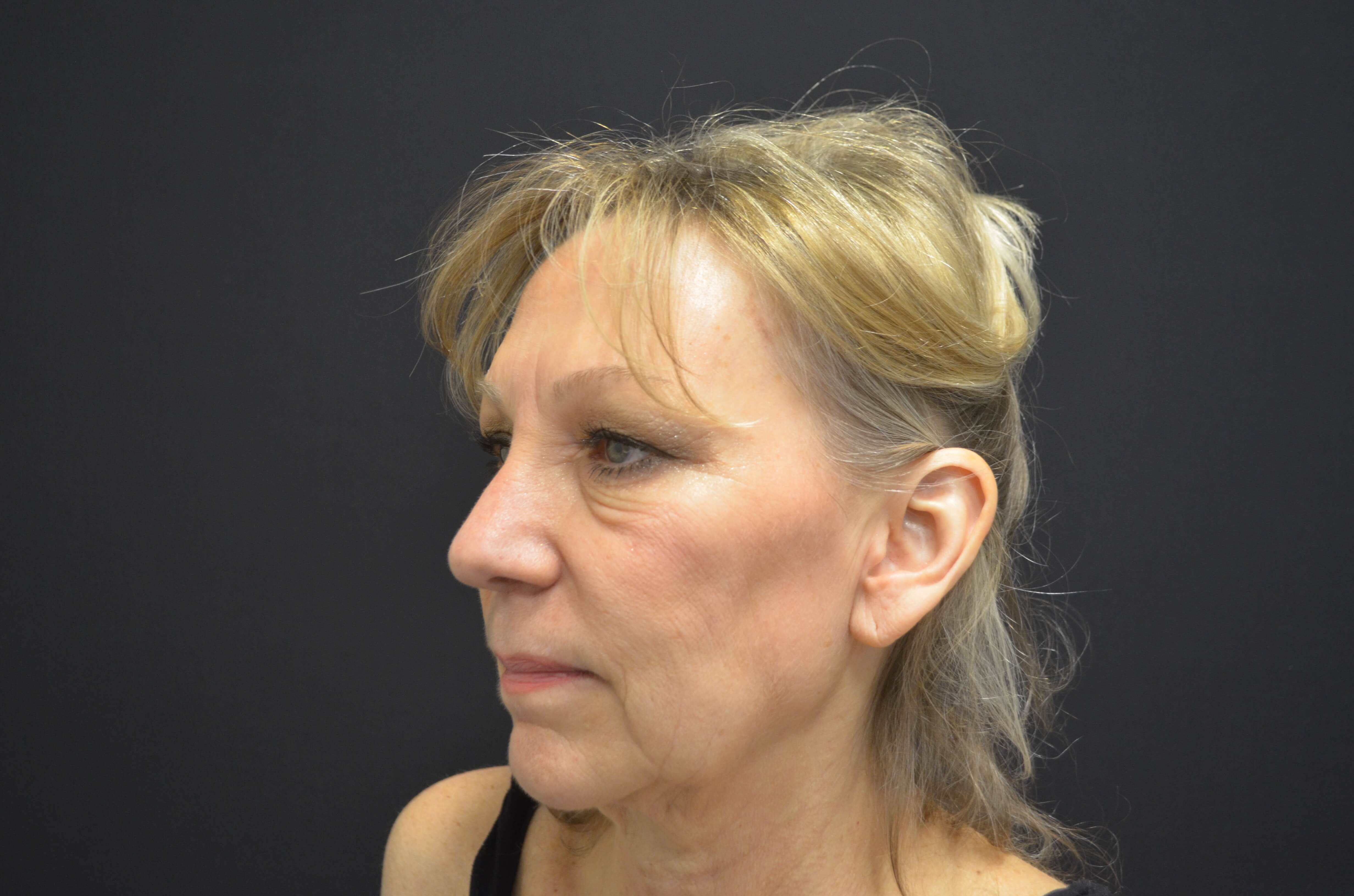 Natural Lower Face & Neck Lift Before