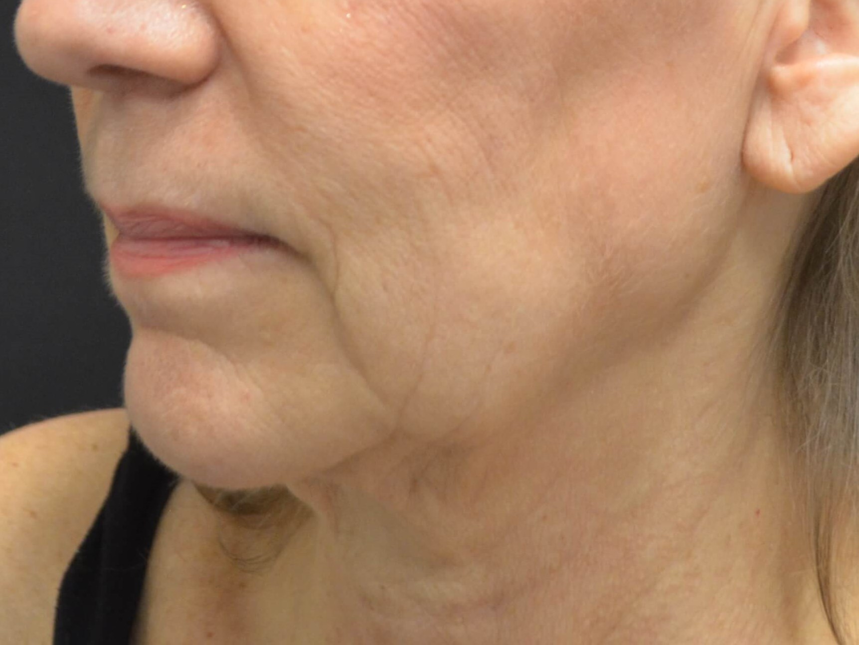 Natural Lower Face & Neck Lift Before