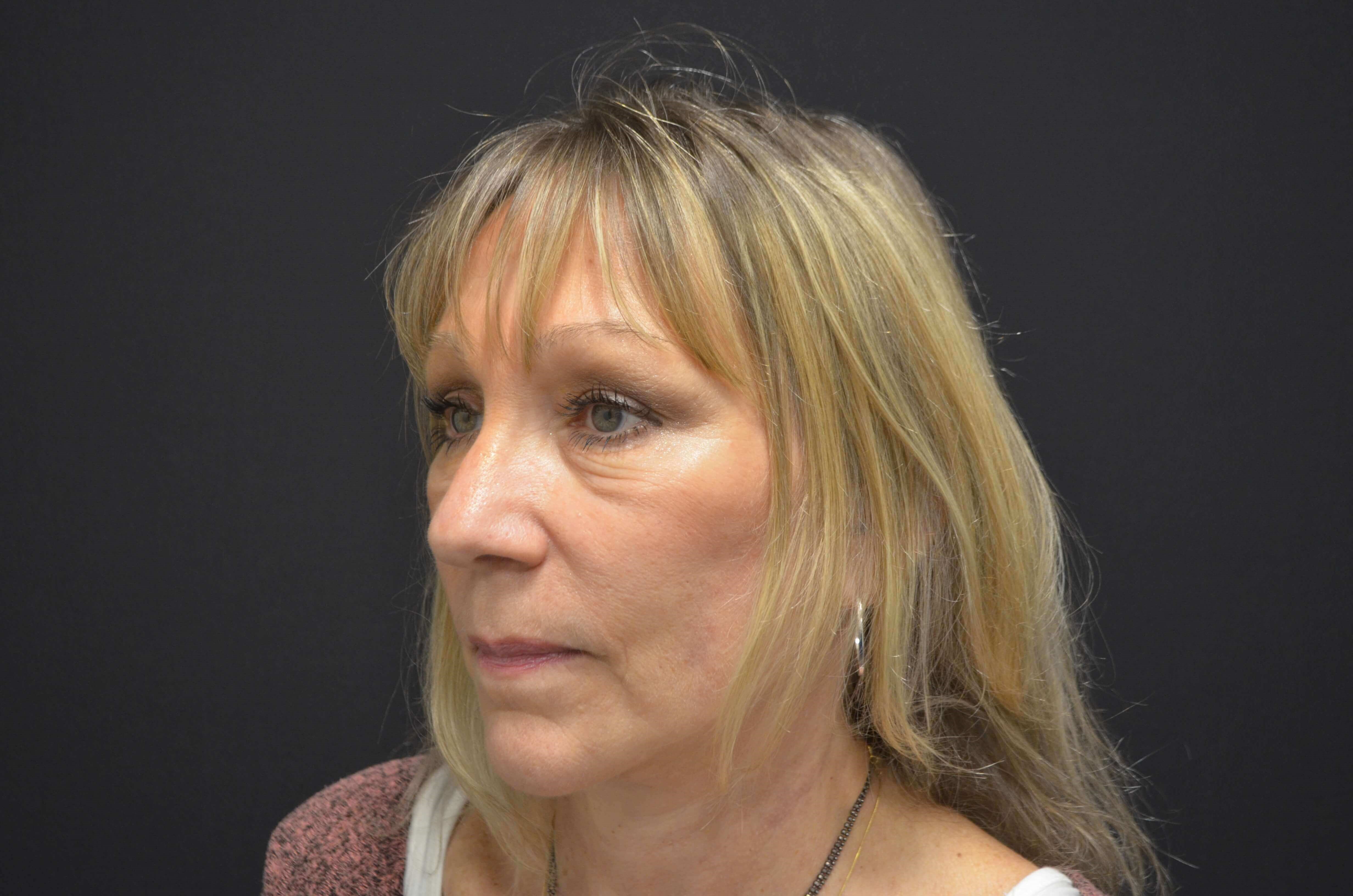 Natural Lower Face & Neck Lift After