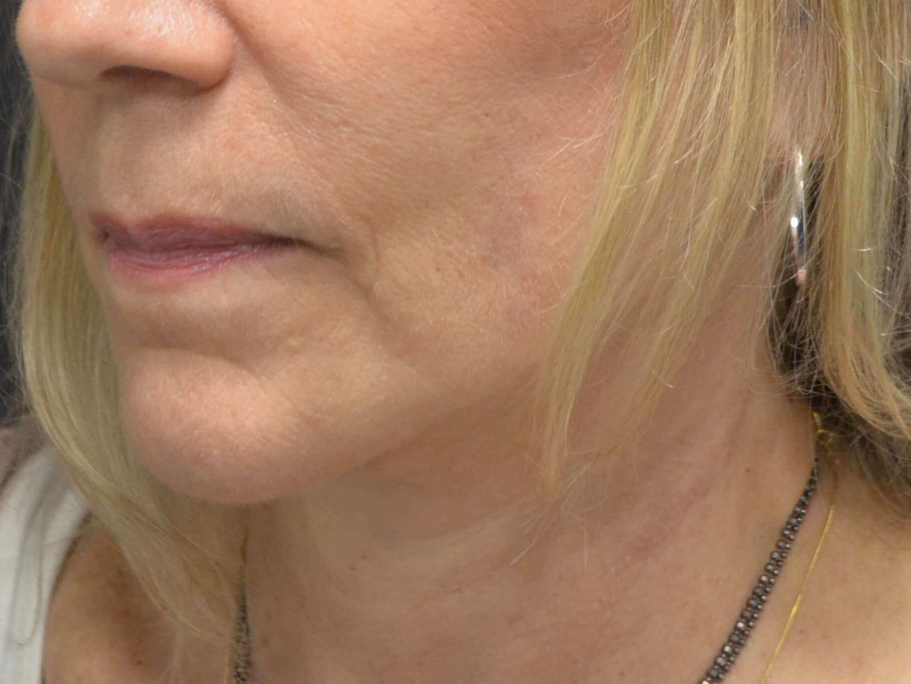Natural Lower Face & Neck Lift After