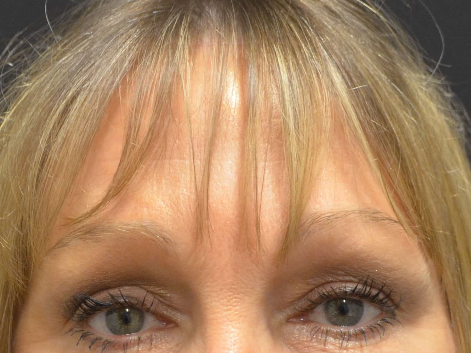 Brow Lift & Upper Eyelid Lift After
