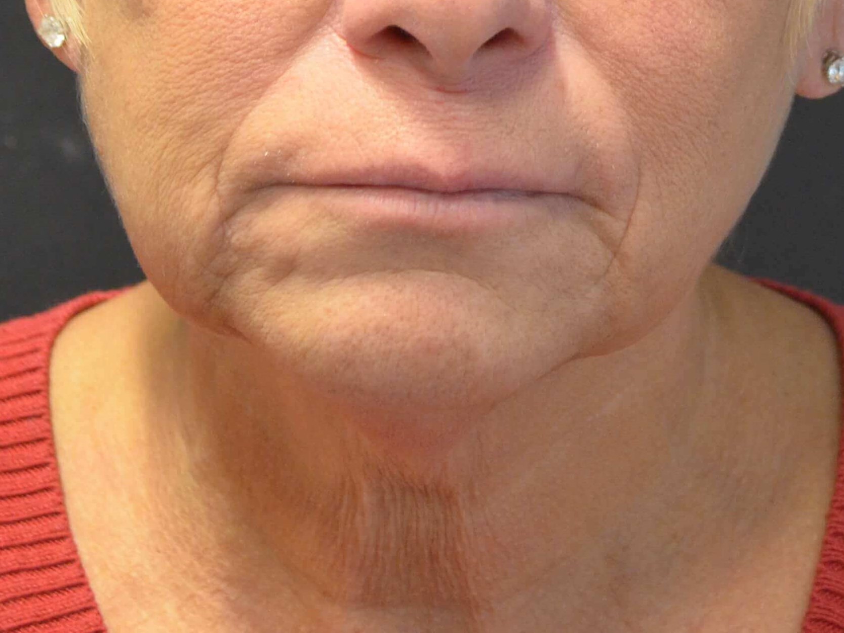 Natural Lower Face & Neck Lift Before