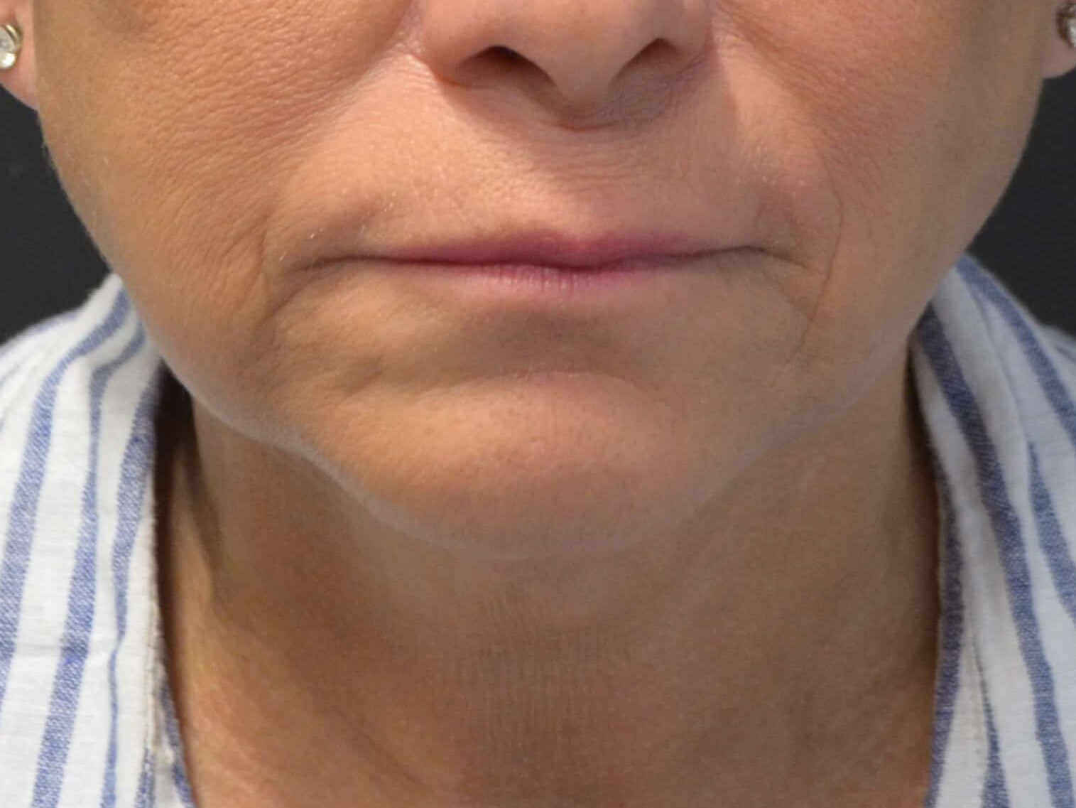 Natural Lower Face & Neck Lift After