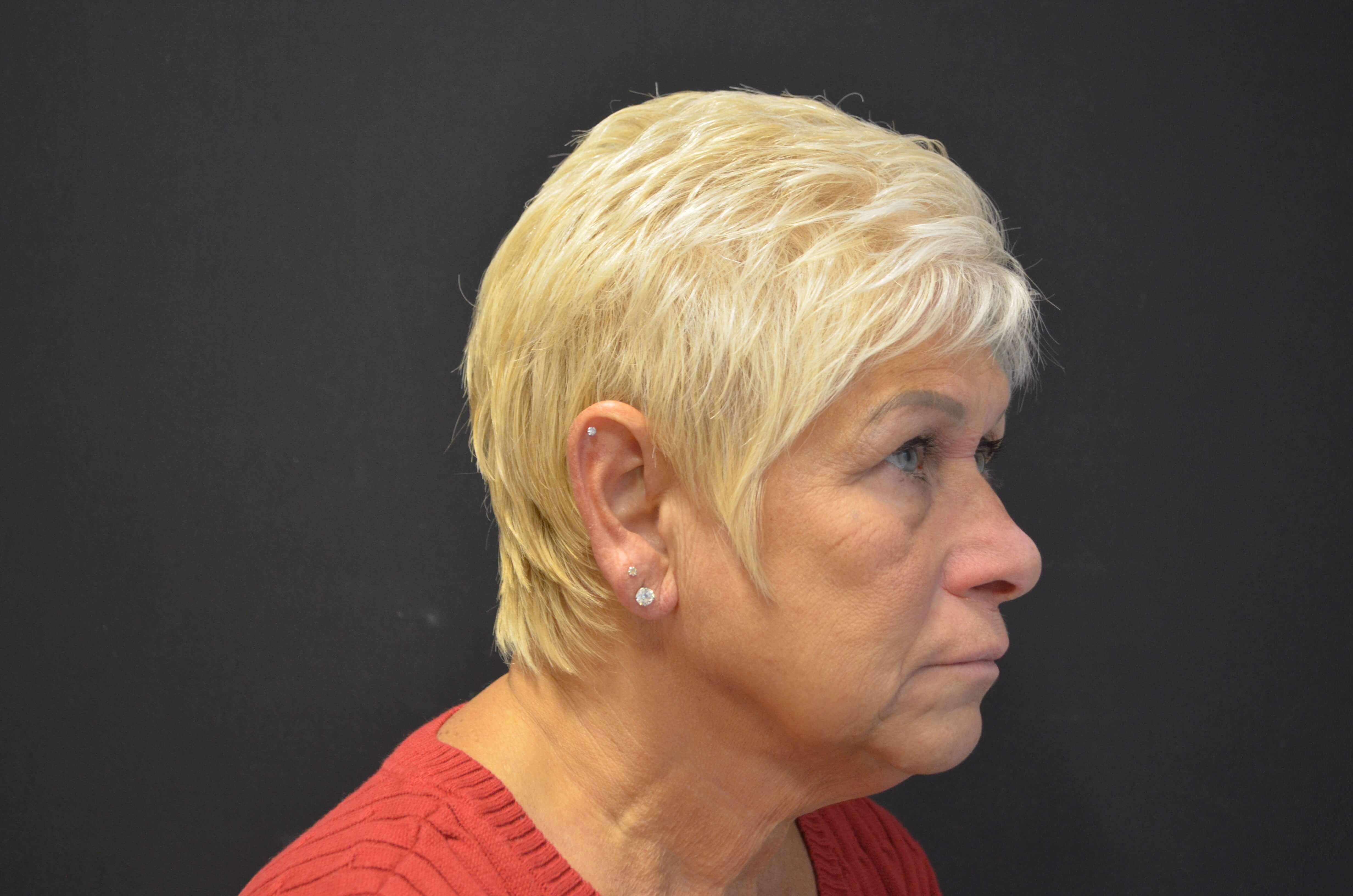 Natural Lower Face & Neck Lift Before
