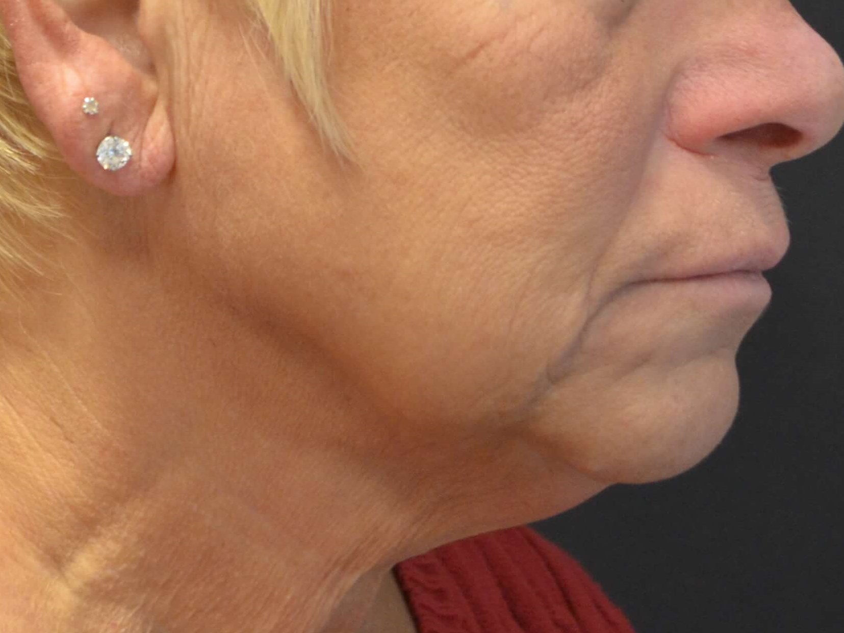 Natural Lower Face & Neck Lift Before