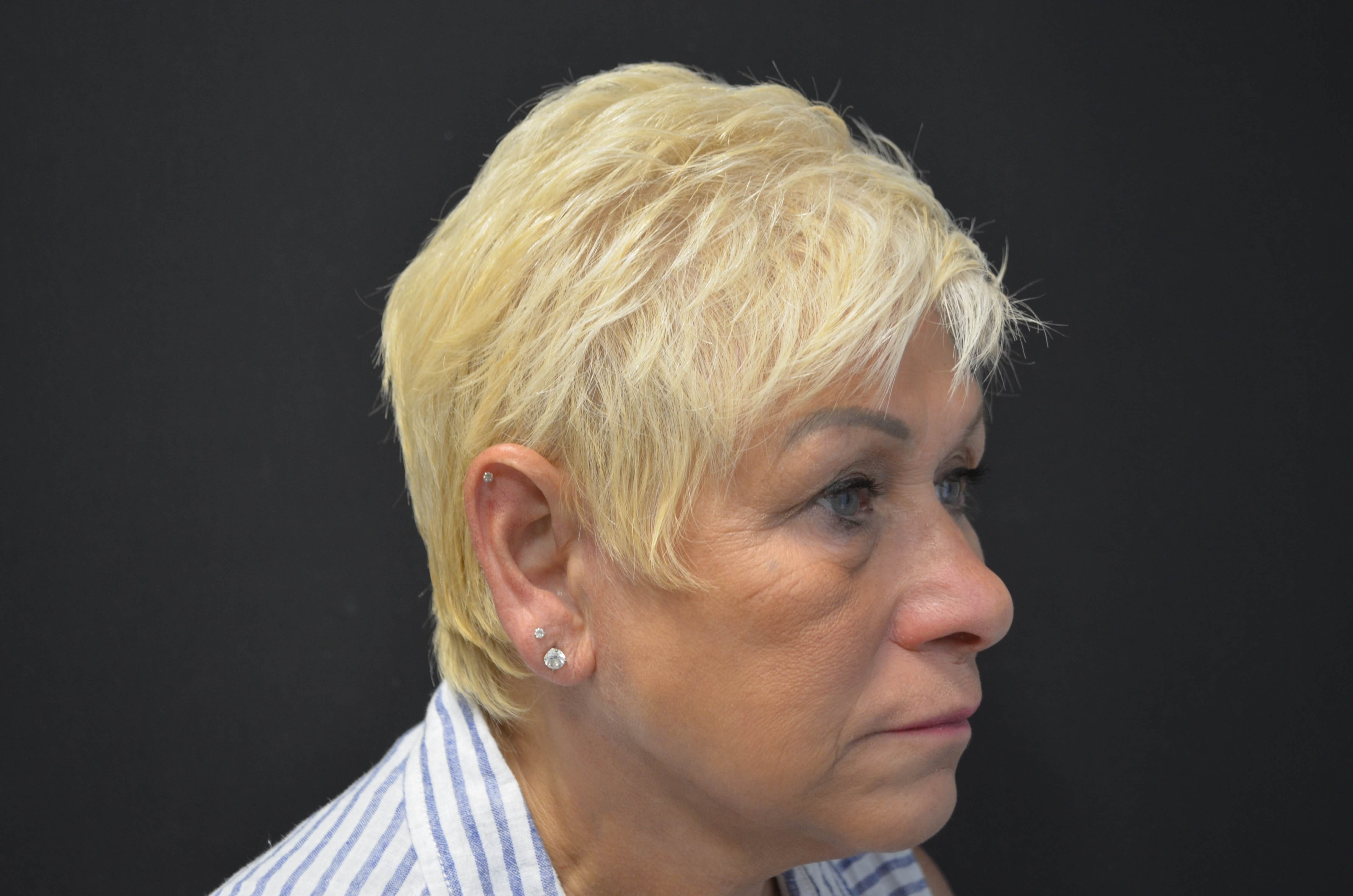 Natural Lower Face & Neck Lift After