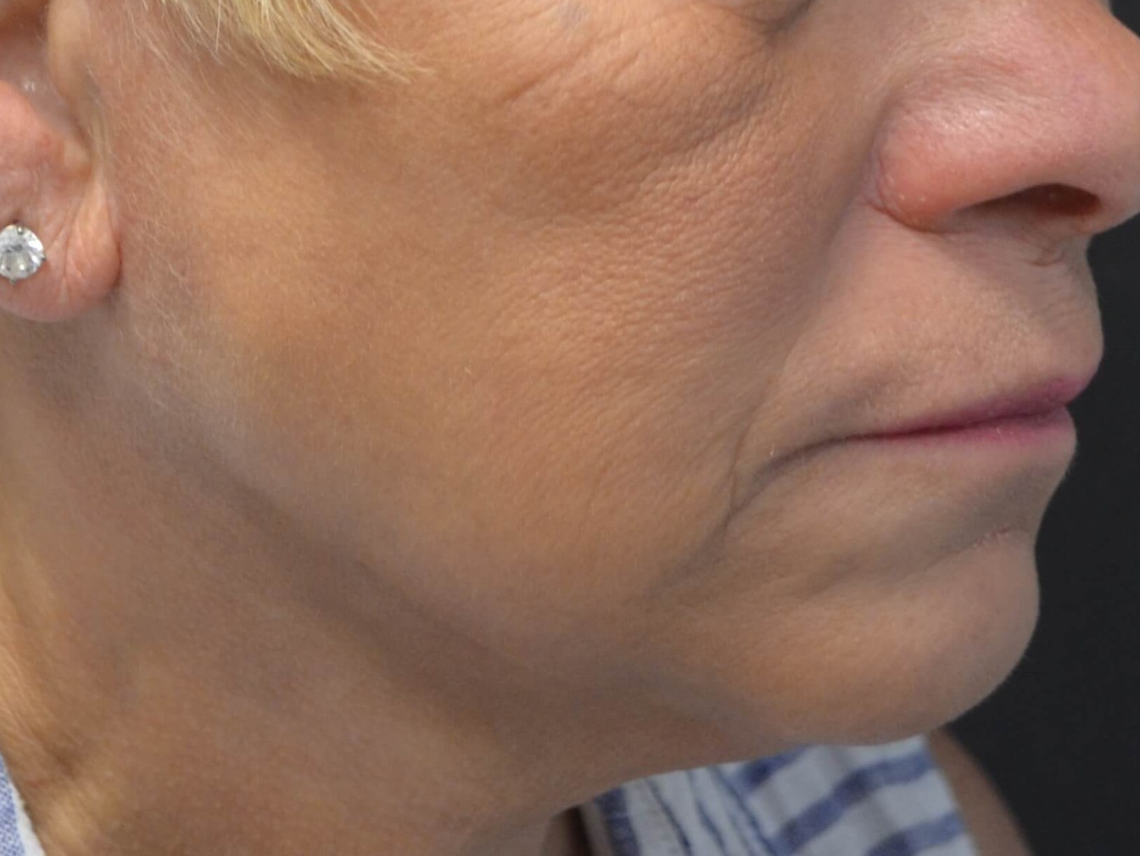 Natural Lower Face & Neck Lift After