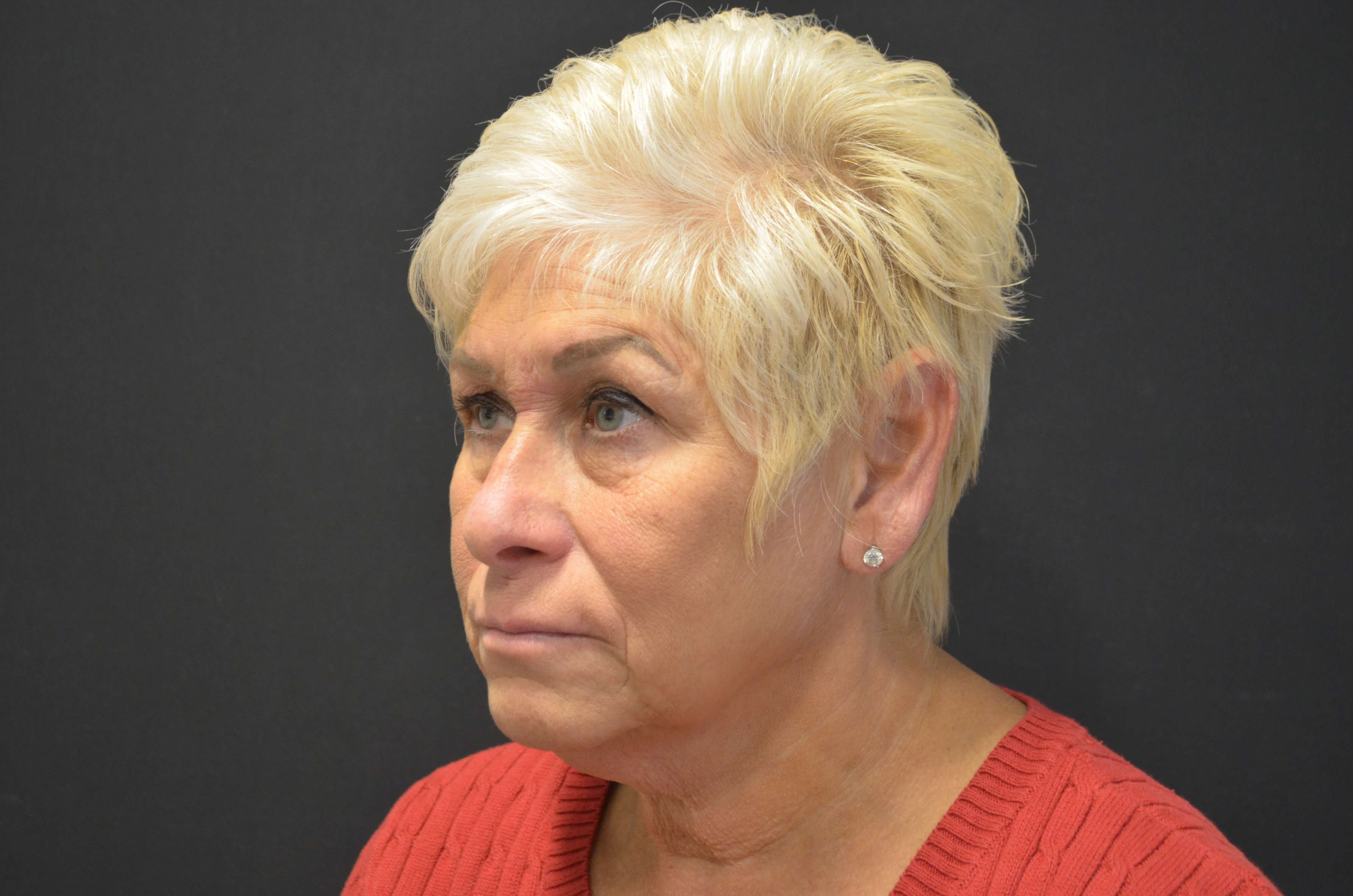Natural Lower Face & Neck Lift Before