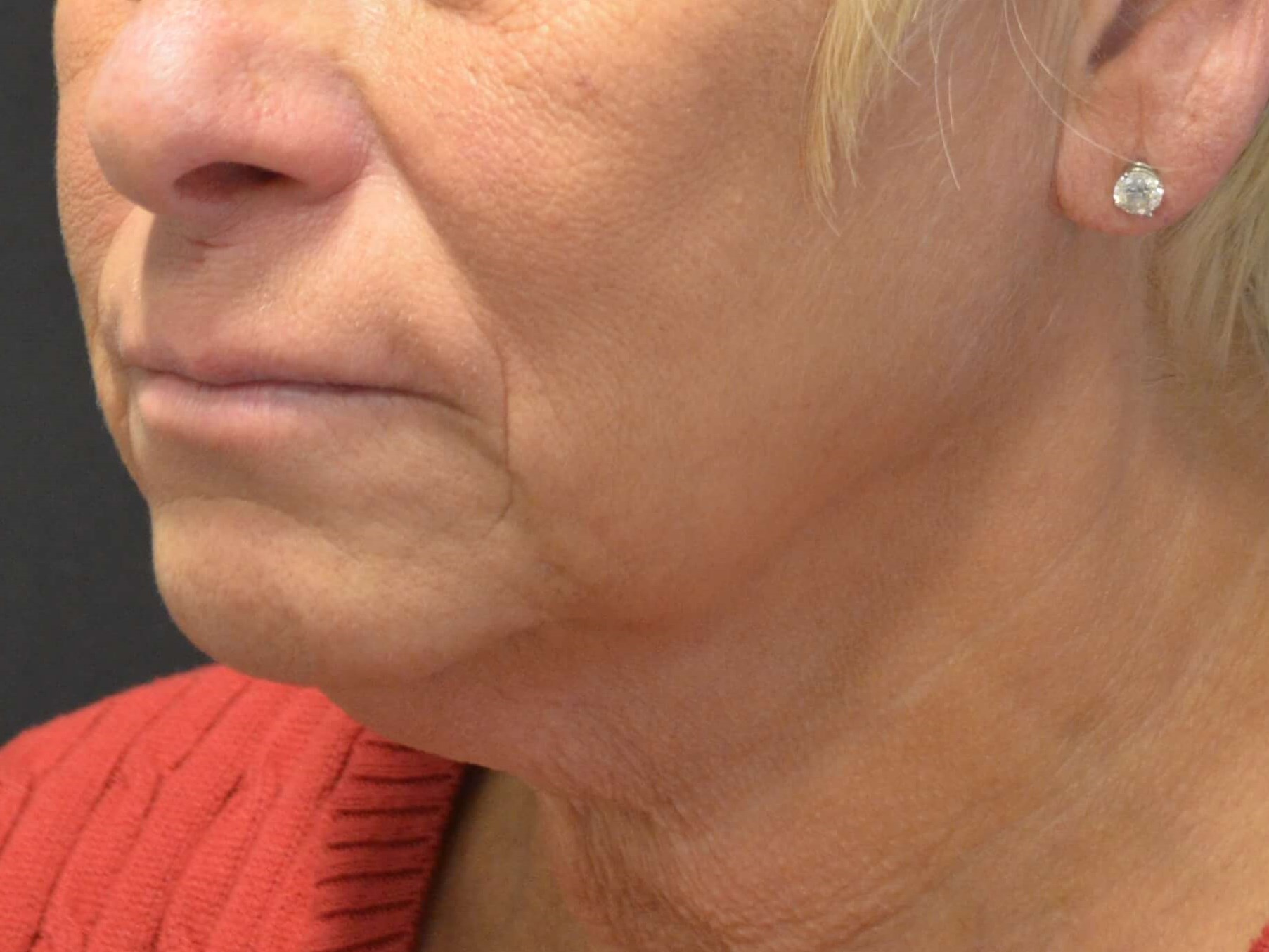 Natural Lower Face & Neck Lift Before