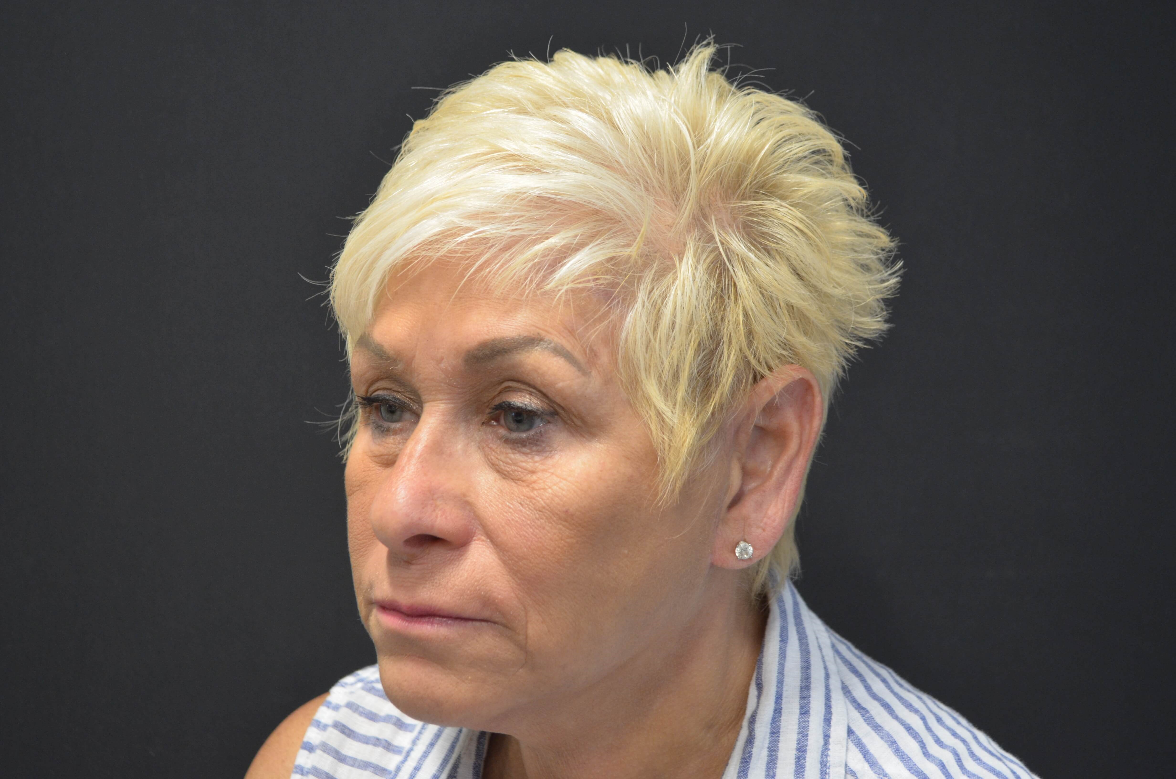 Natural Lower Face & Neck Lift After