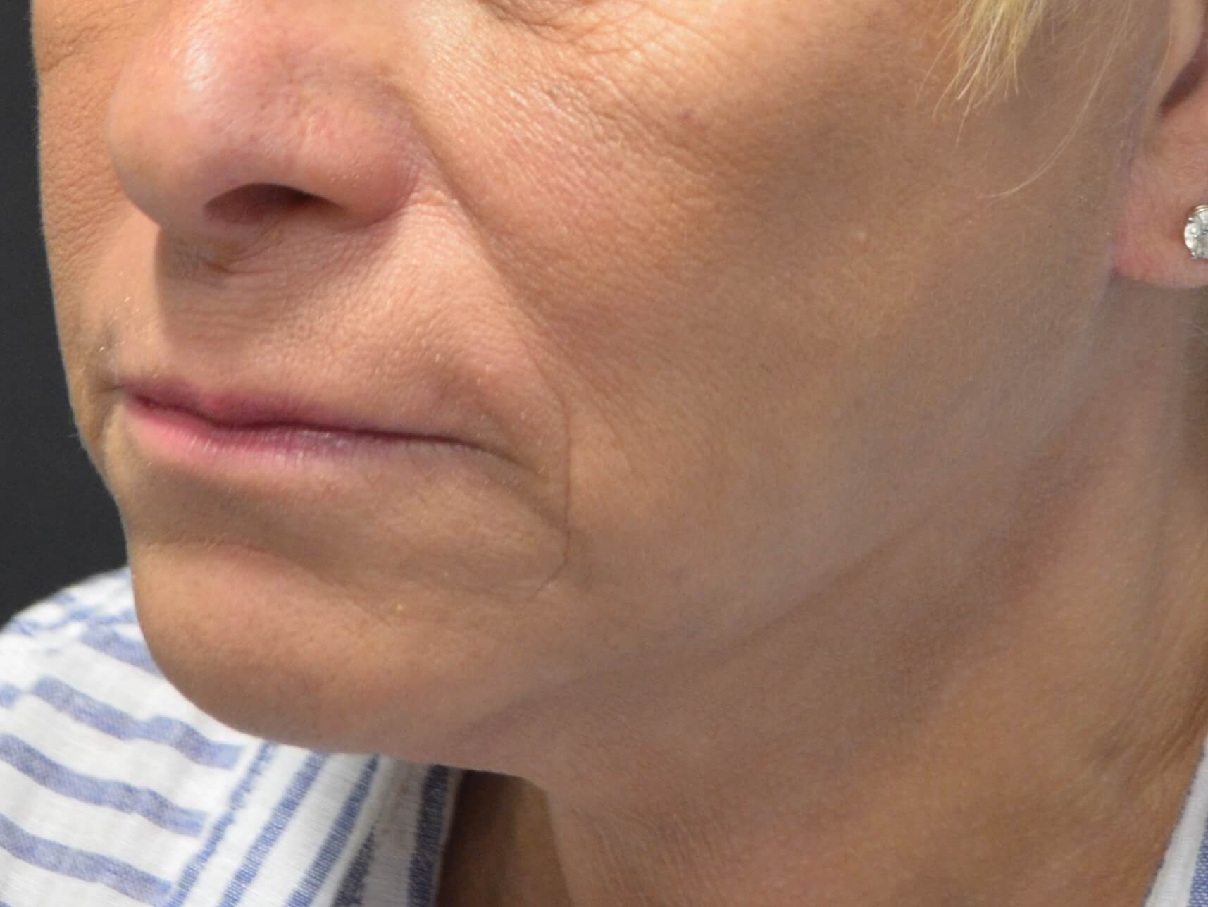 Natural Lower Face & Neck Lift After