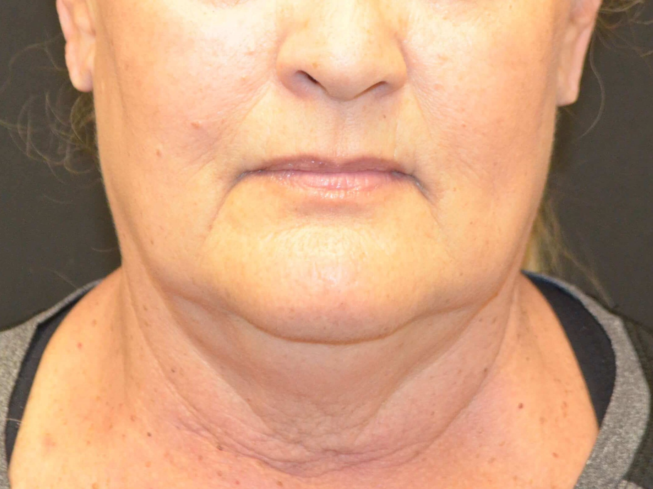 Natural Lower Face & Neck Lift Before