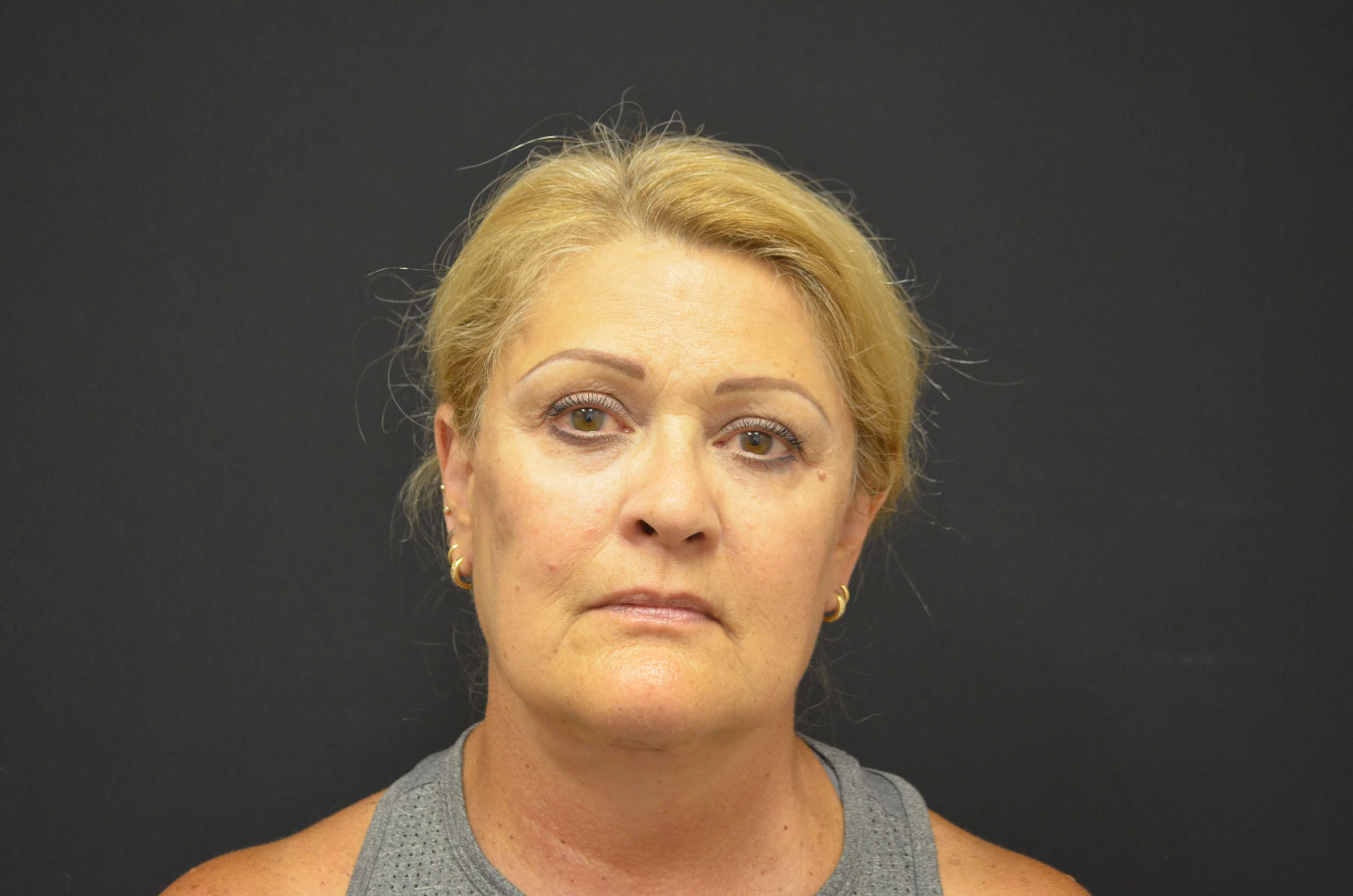 Natural Lower Face & Neck Lift After