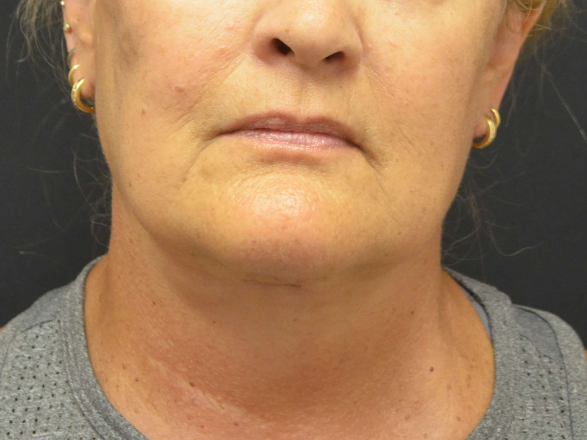 Natural Lower Face & Neck Lift After
