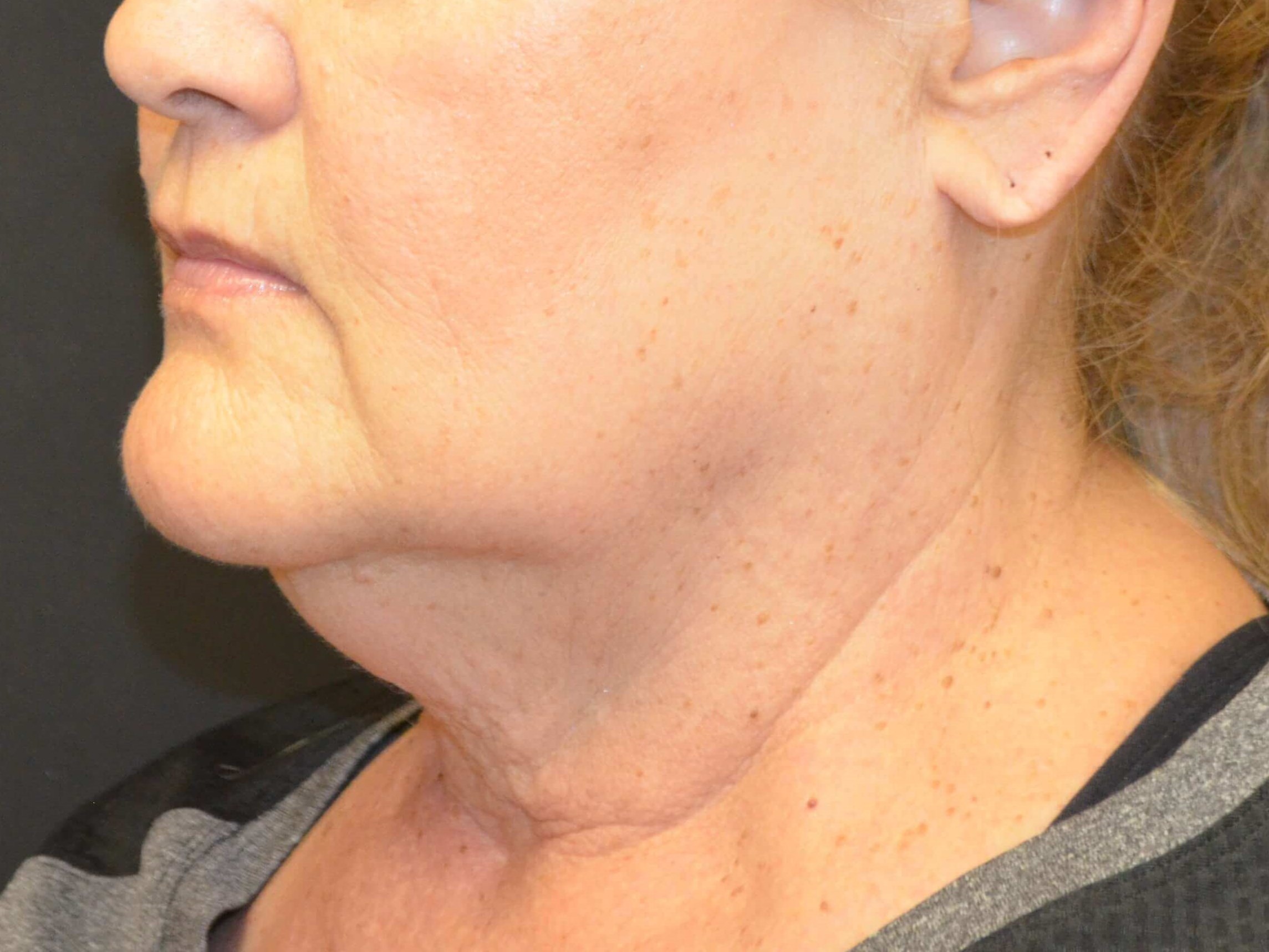 Natural Lower Face & Neck Lift Before