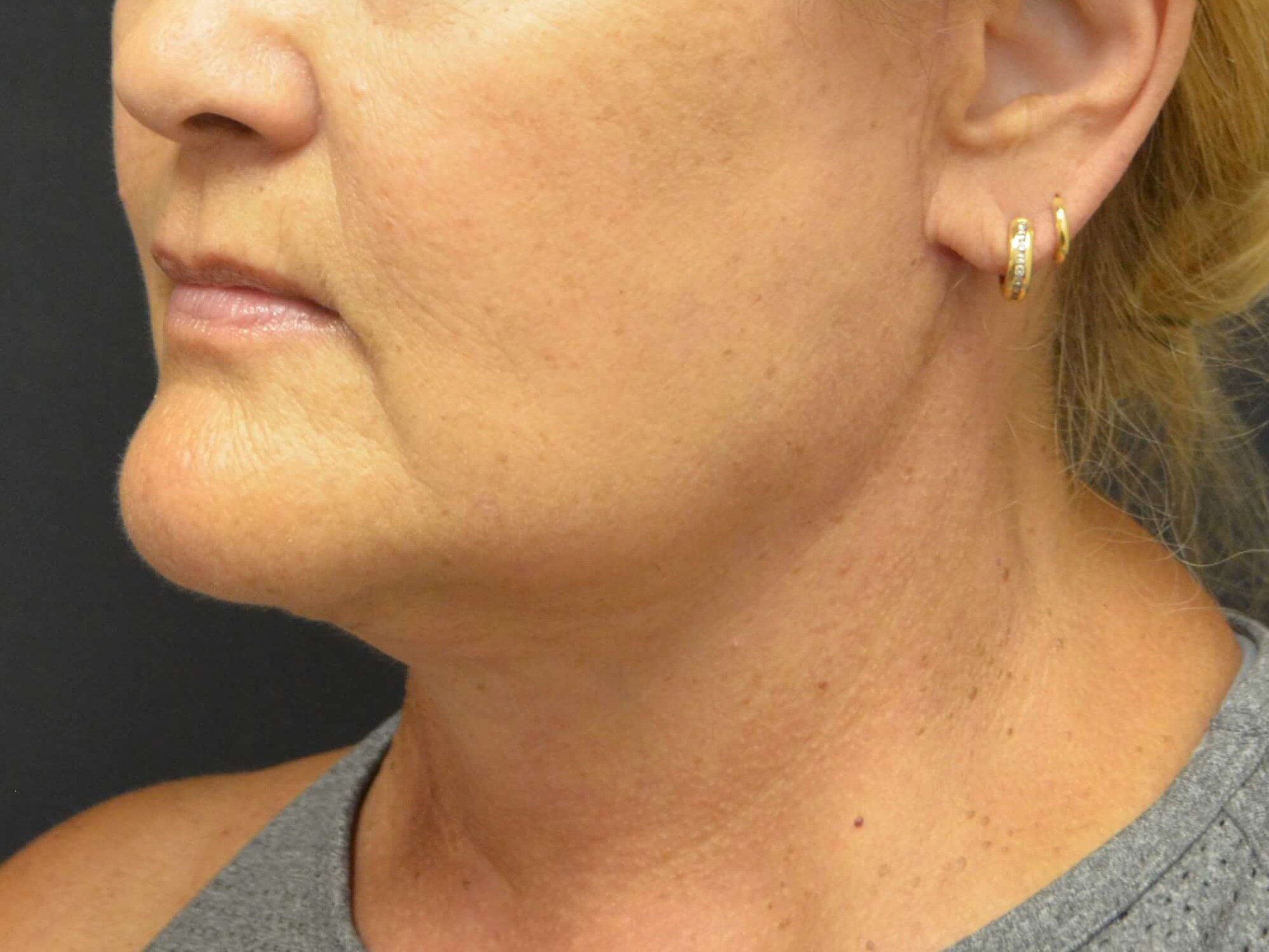 Natural Lower Face & Neck Lift After