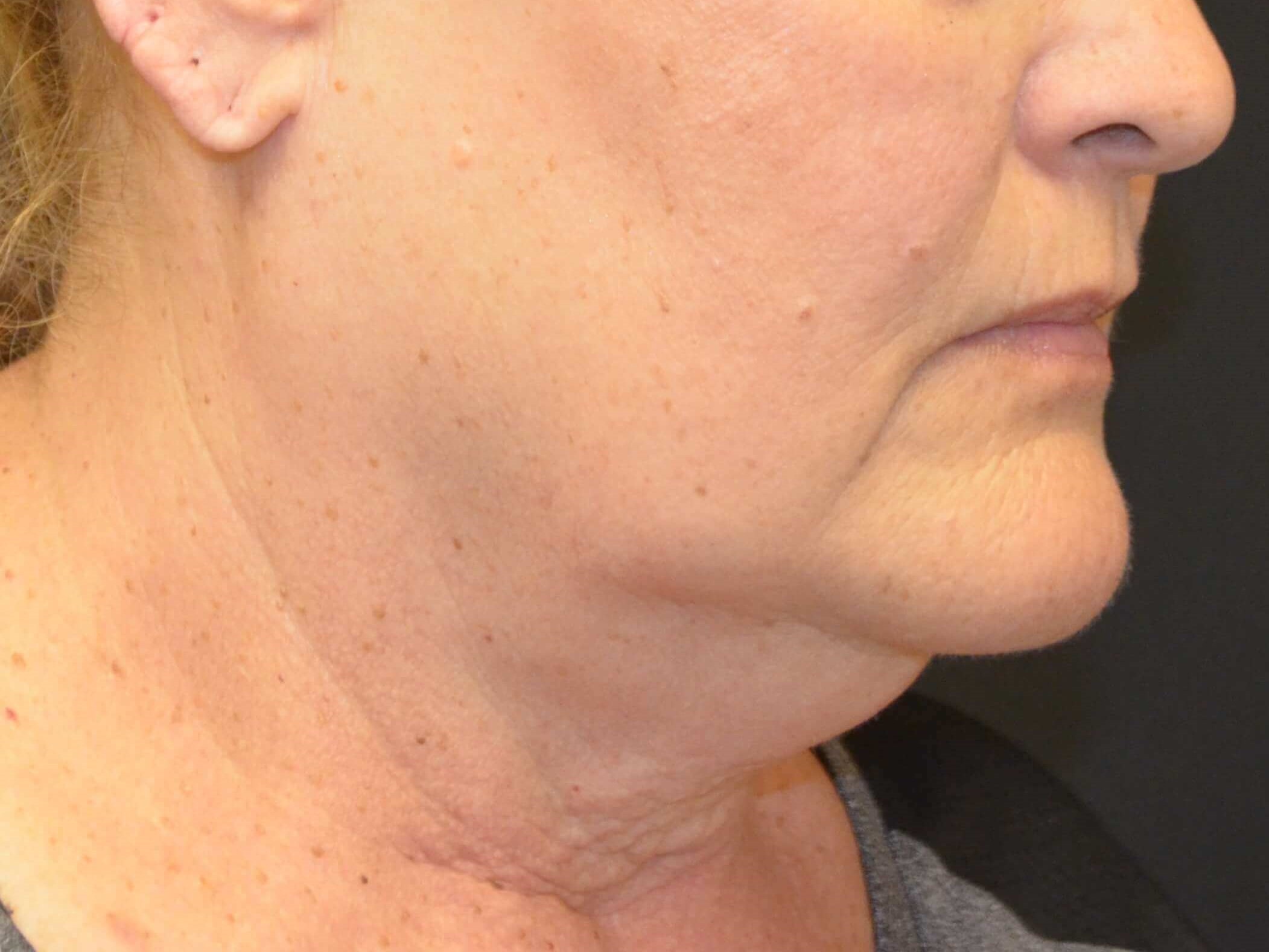 Natural Lower Face & Neck Lift Before
