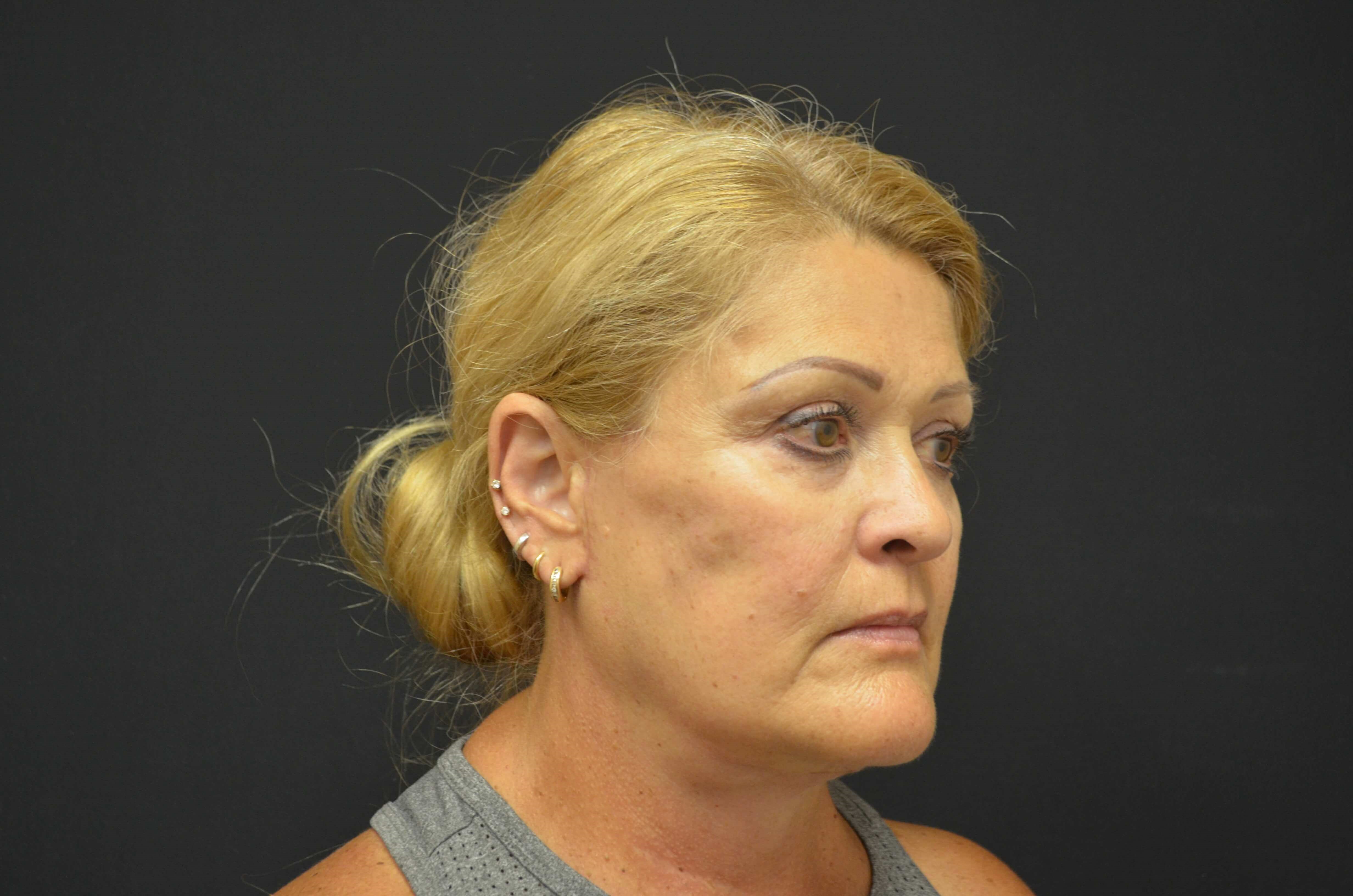 Natural Lower Face & Neck Lift After