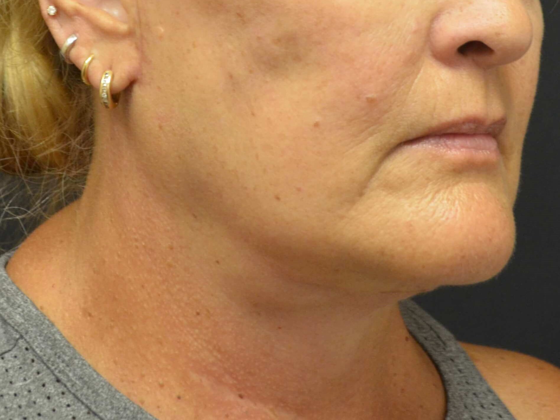 Natural Lower Face & Neck Lift After