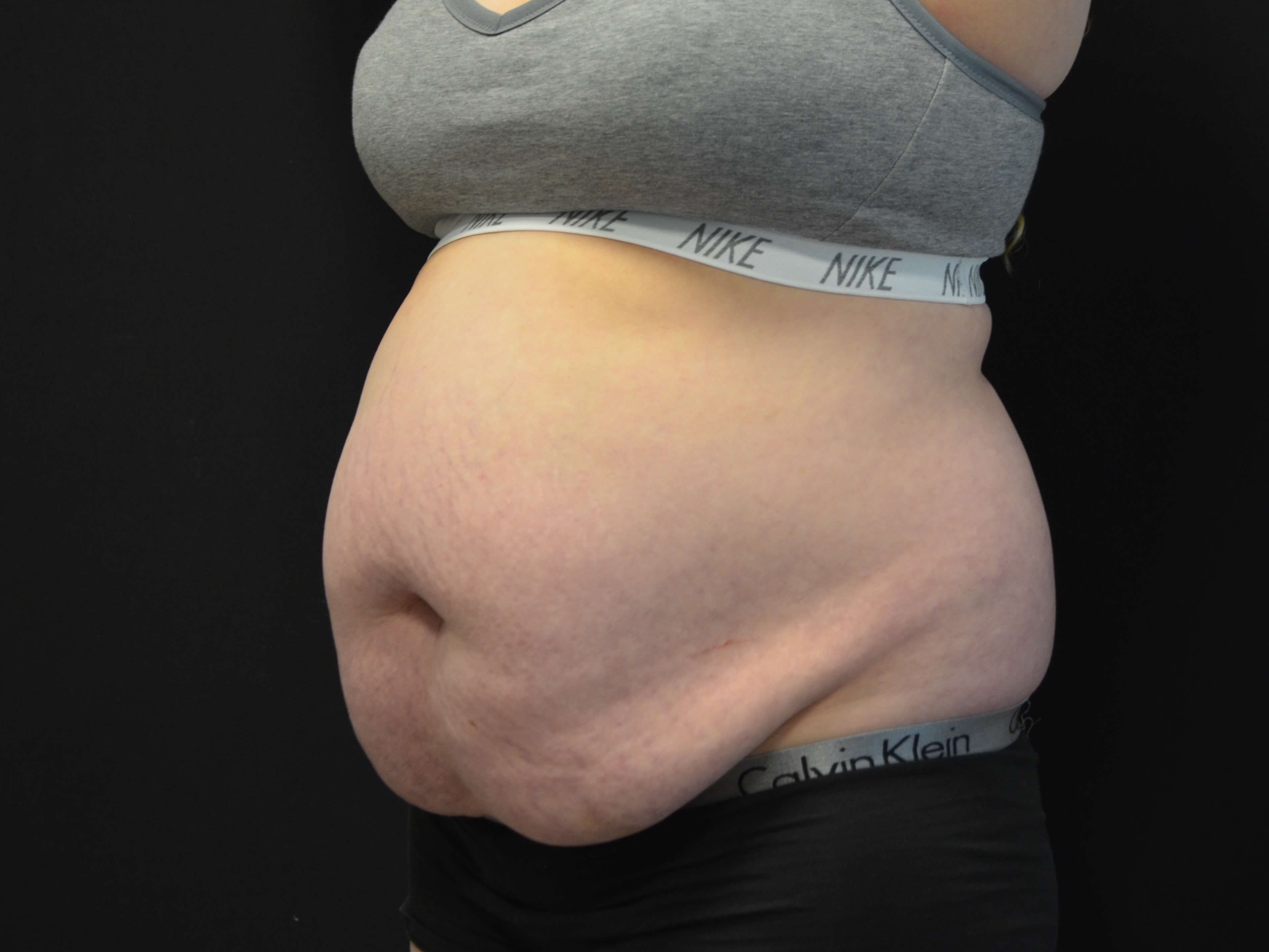 Tummy Tuck- Hinsdale, IL Before