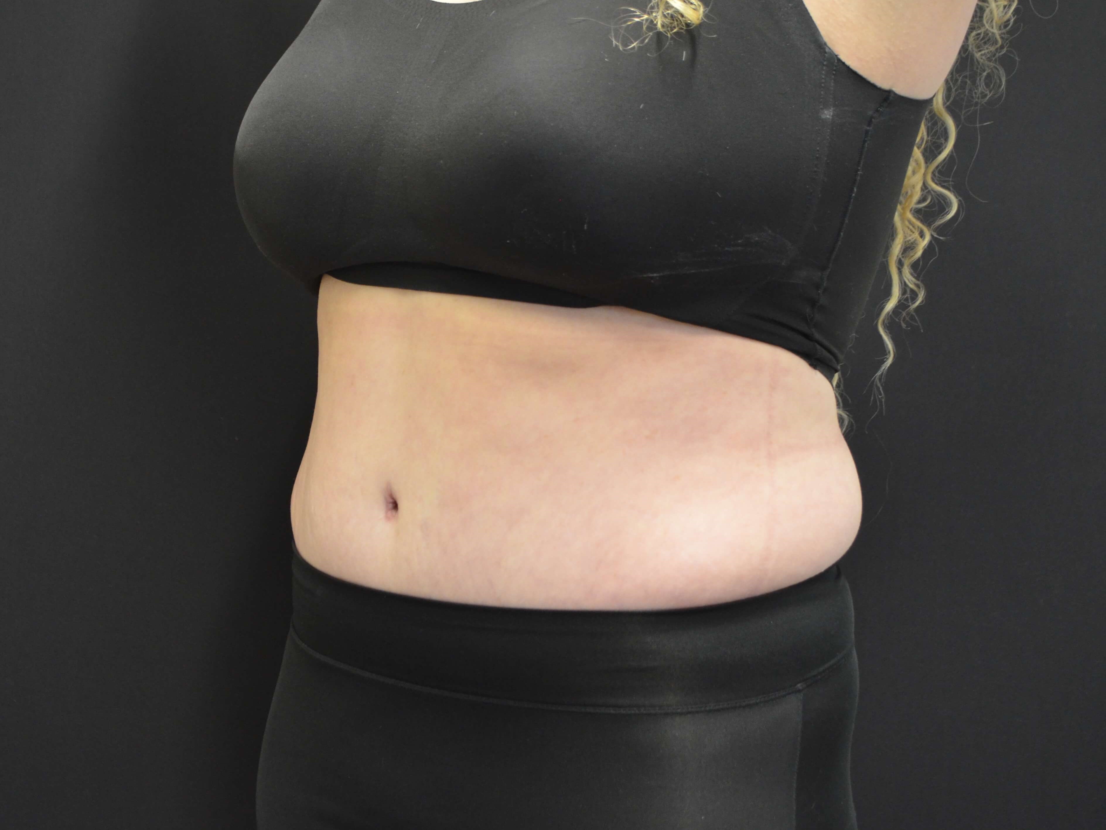 Tummy Tuck- Hinsdale, IL After