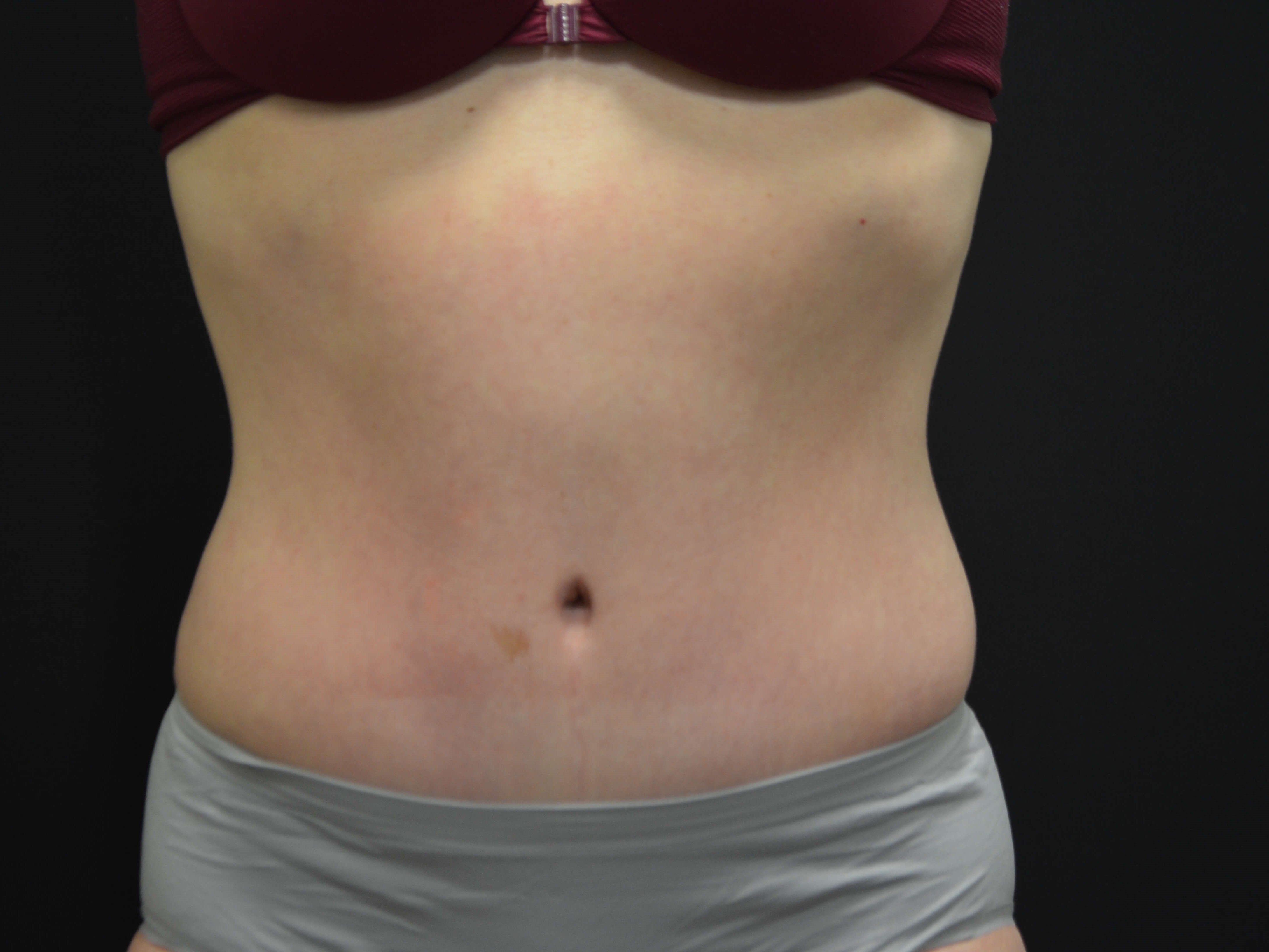 Tummy Tuck- Hinsdale, IL After