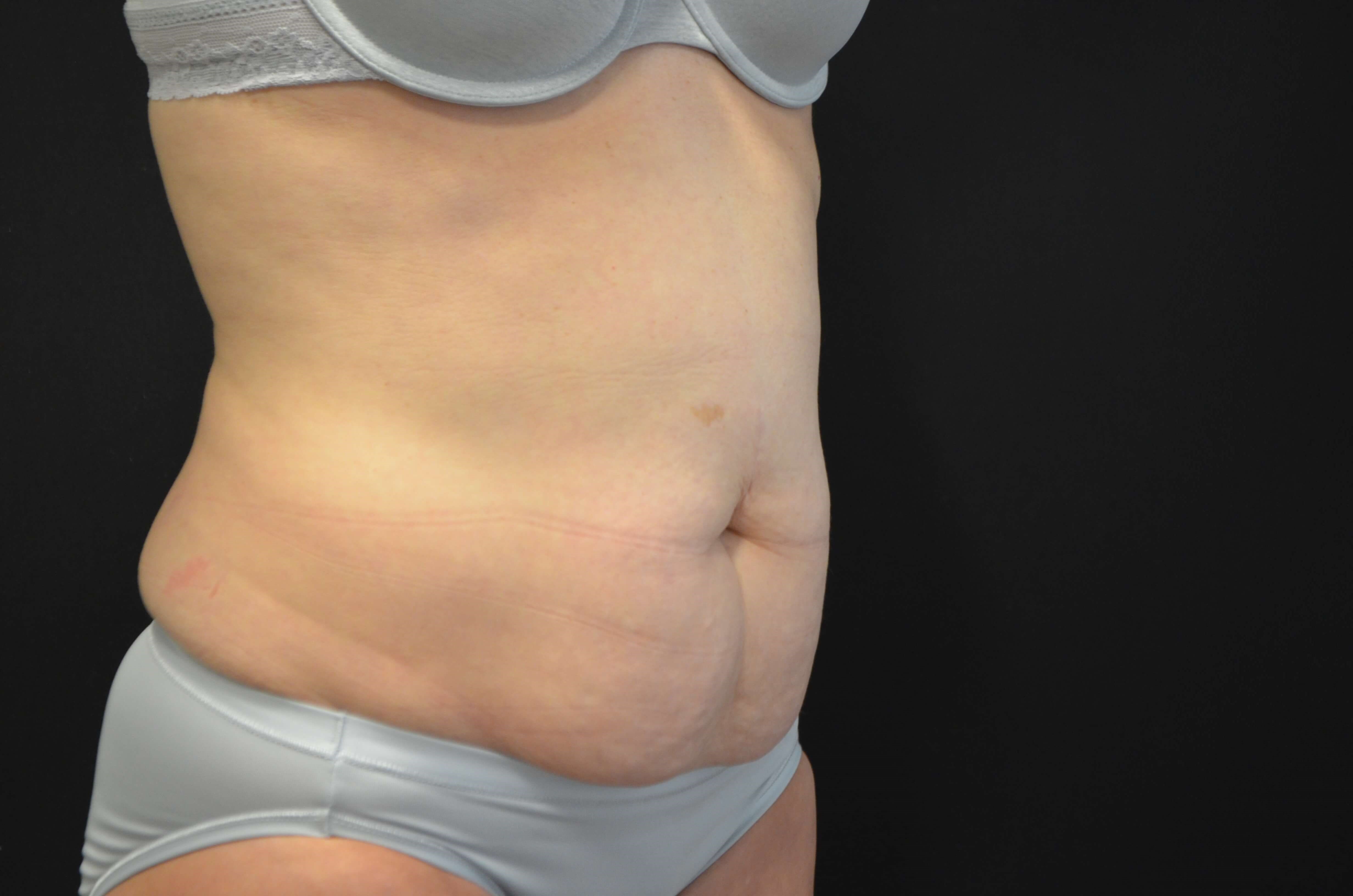 Tummy Tuck- Hinsdale, IL Before