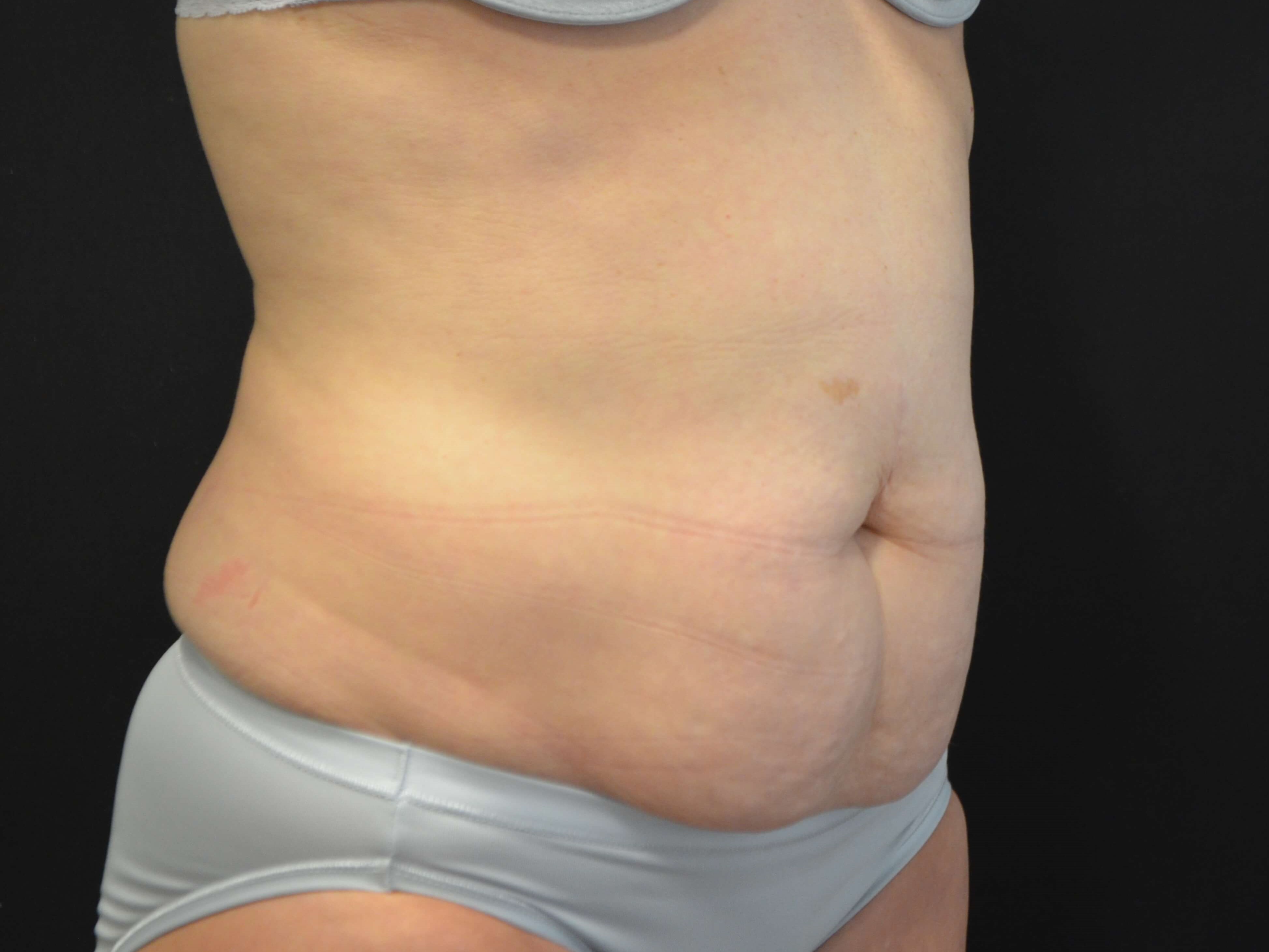 Tummy Tuck- Hinsdale, IL Before