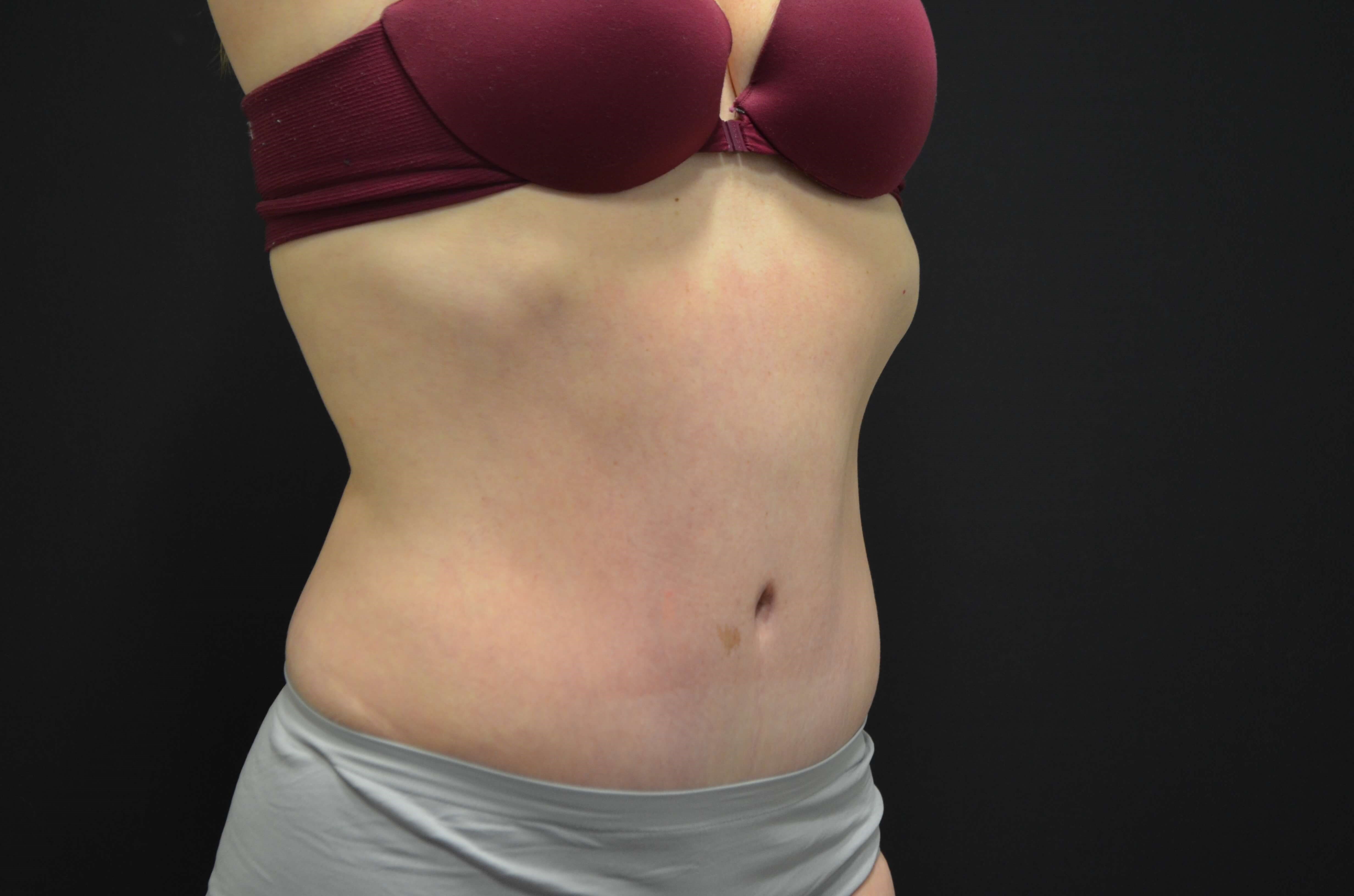 Tummy Tuck- Hinsdale, IL After