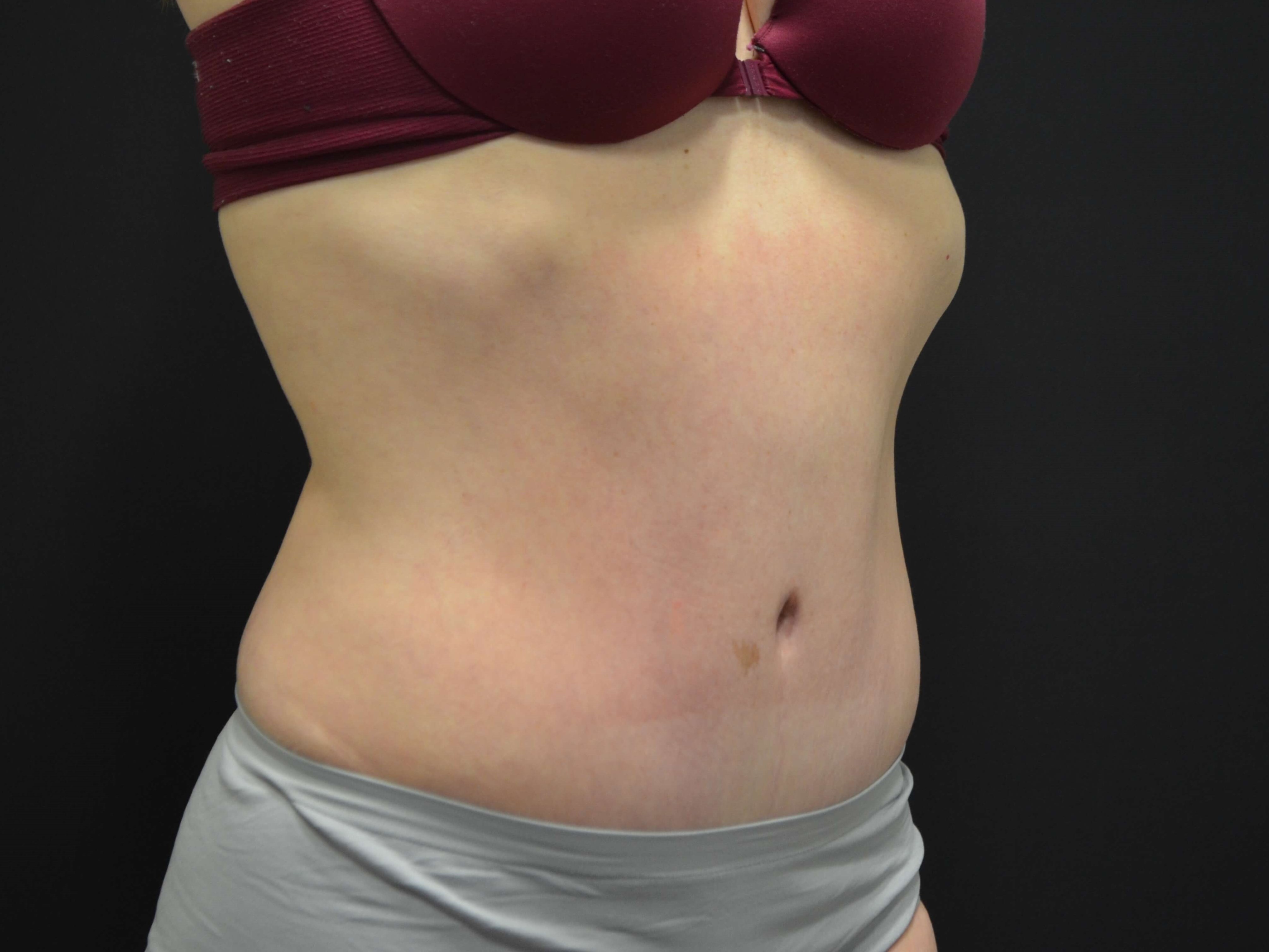 Tummy Tuck- Hinsdale, IL After