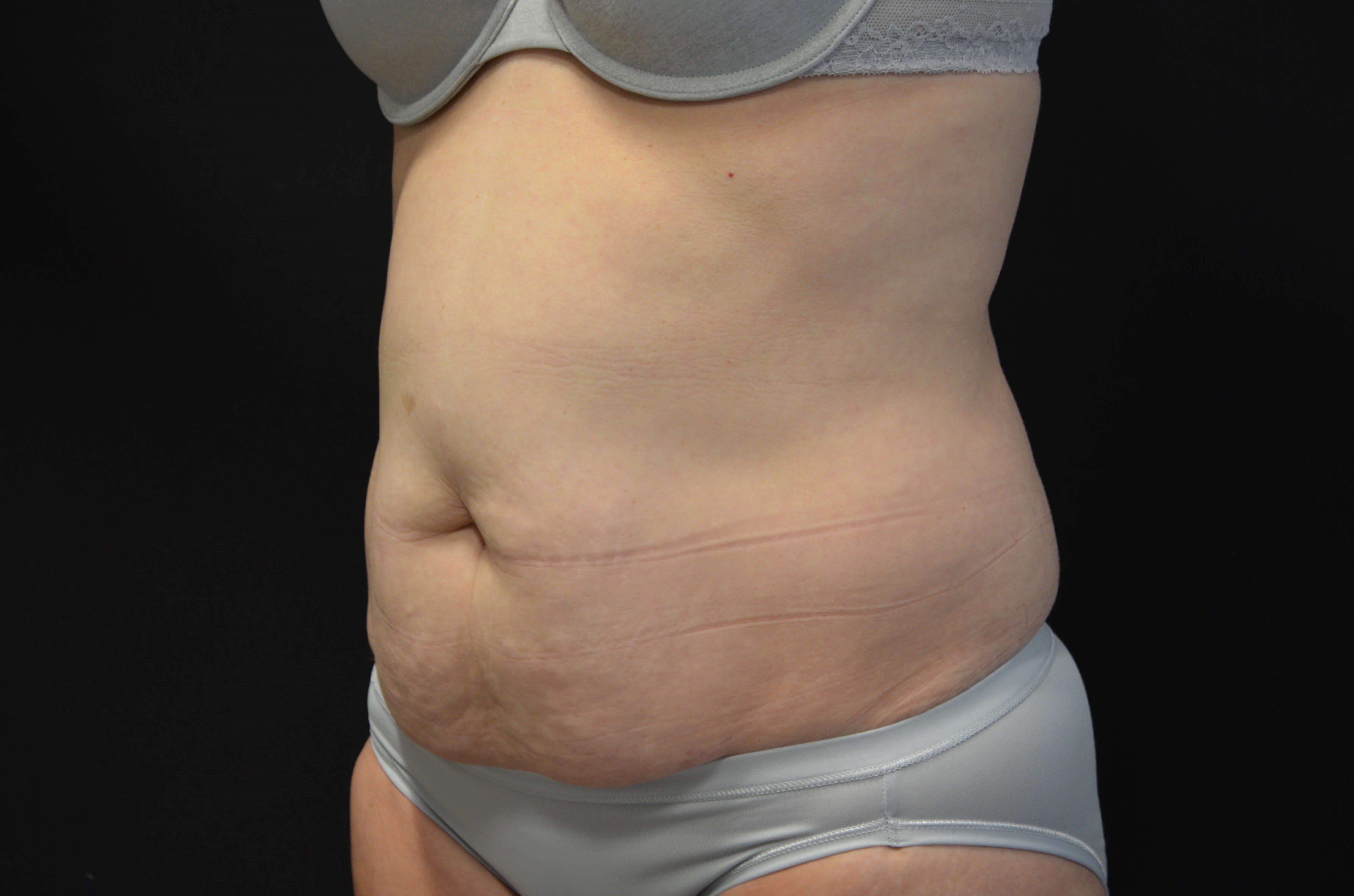 Tummy Tuck- Hinsdale, IL Before