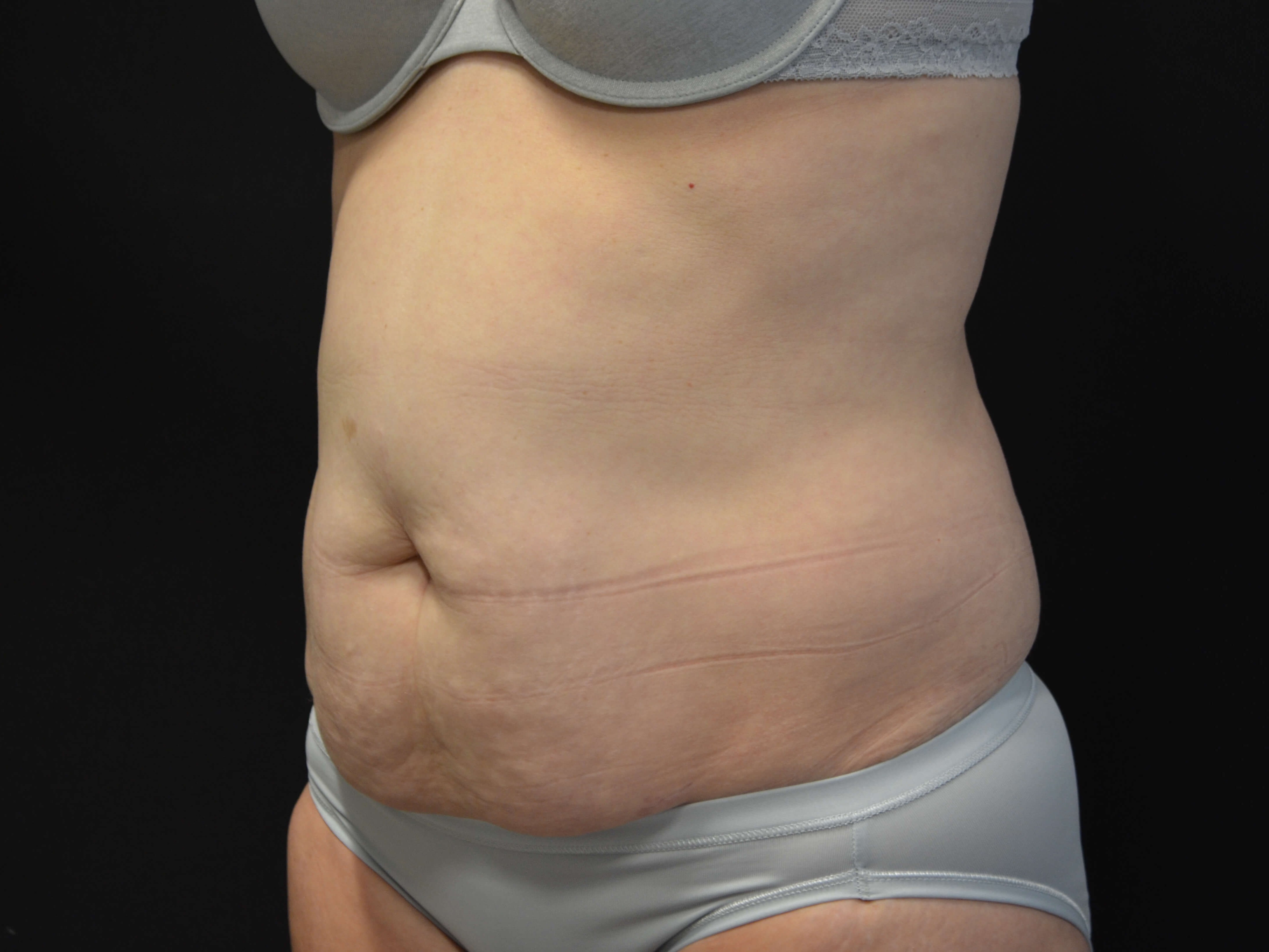 Tummy Tuck- Hinsdale, IL Before