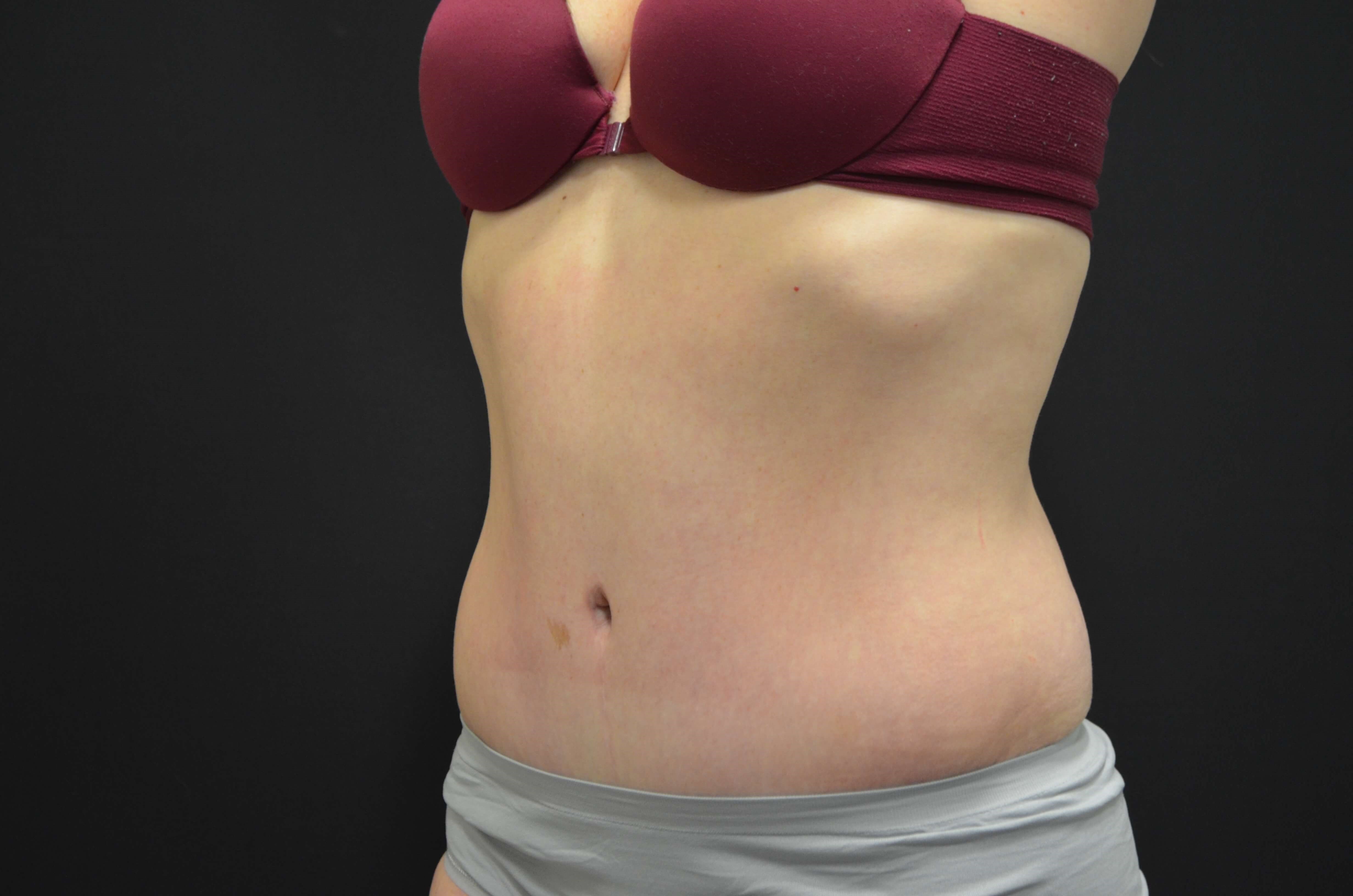 Tummy Tuck- Hinsdale, IL After