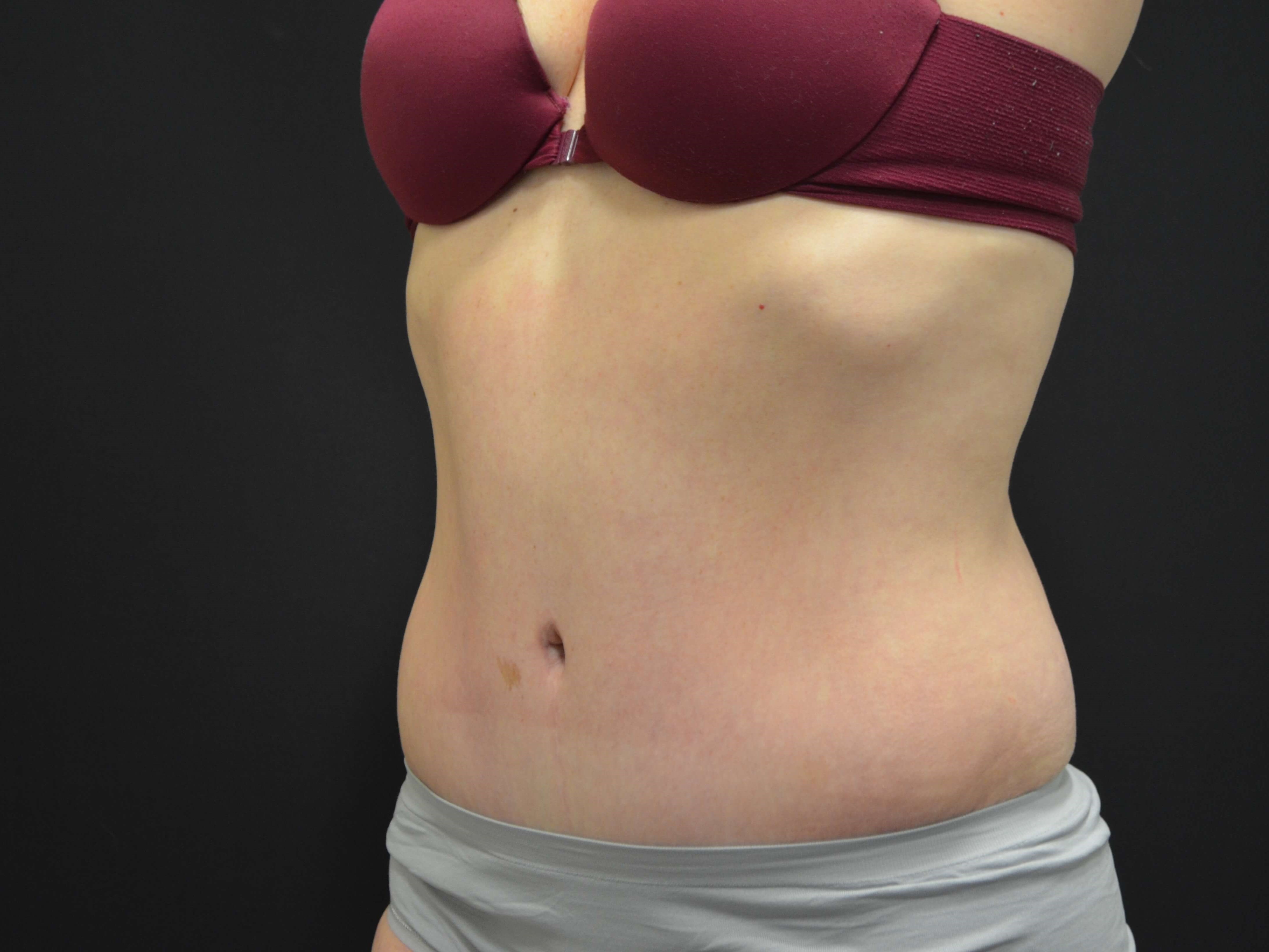 Tummy Tuck- Hinsdale, IL After