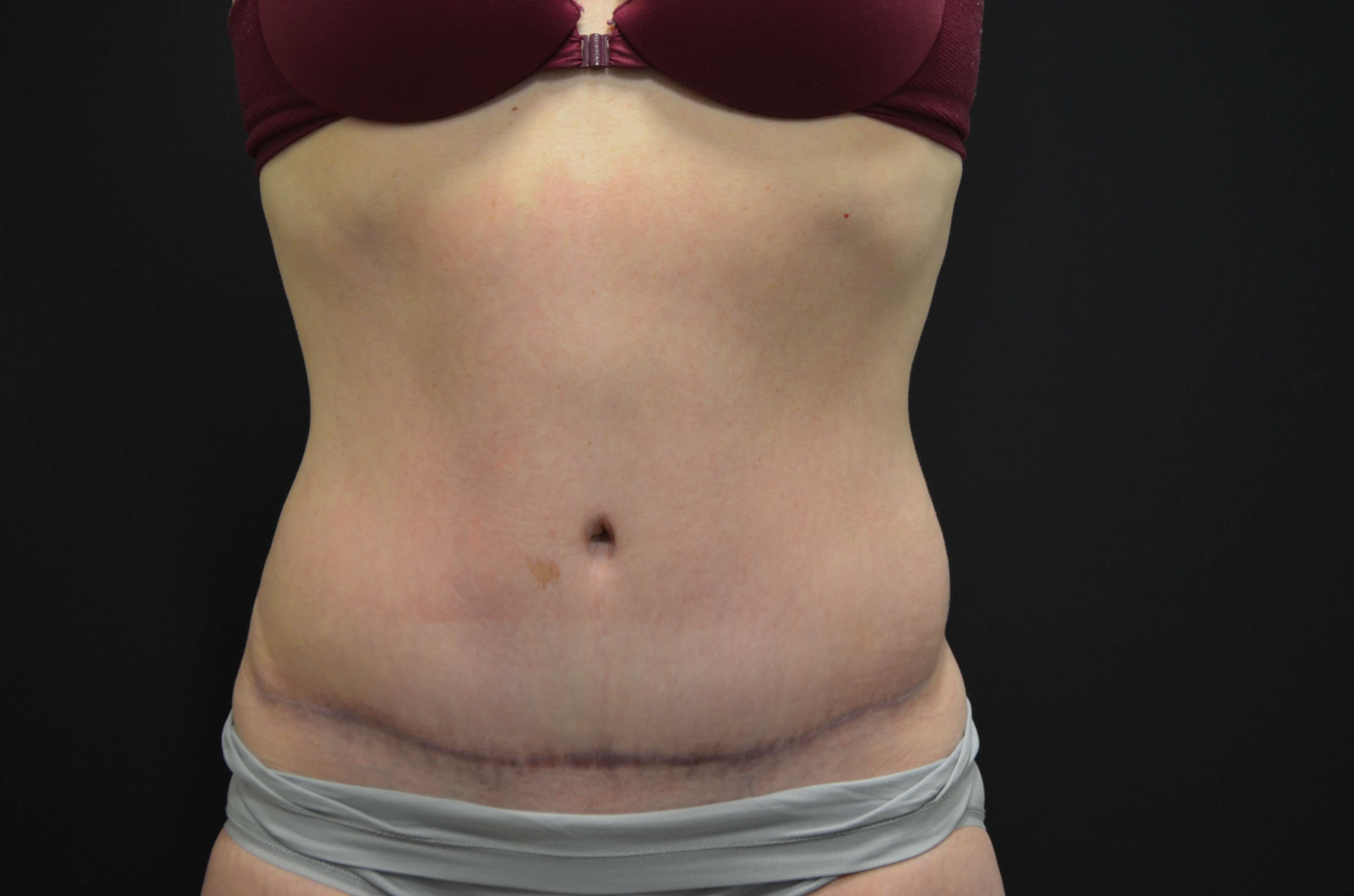 Tummy Tuck- Hinsdale, IL After
