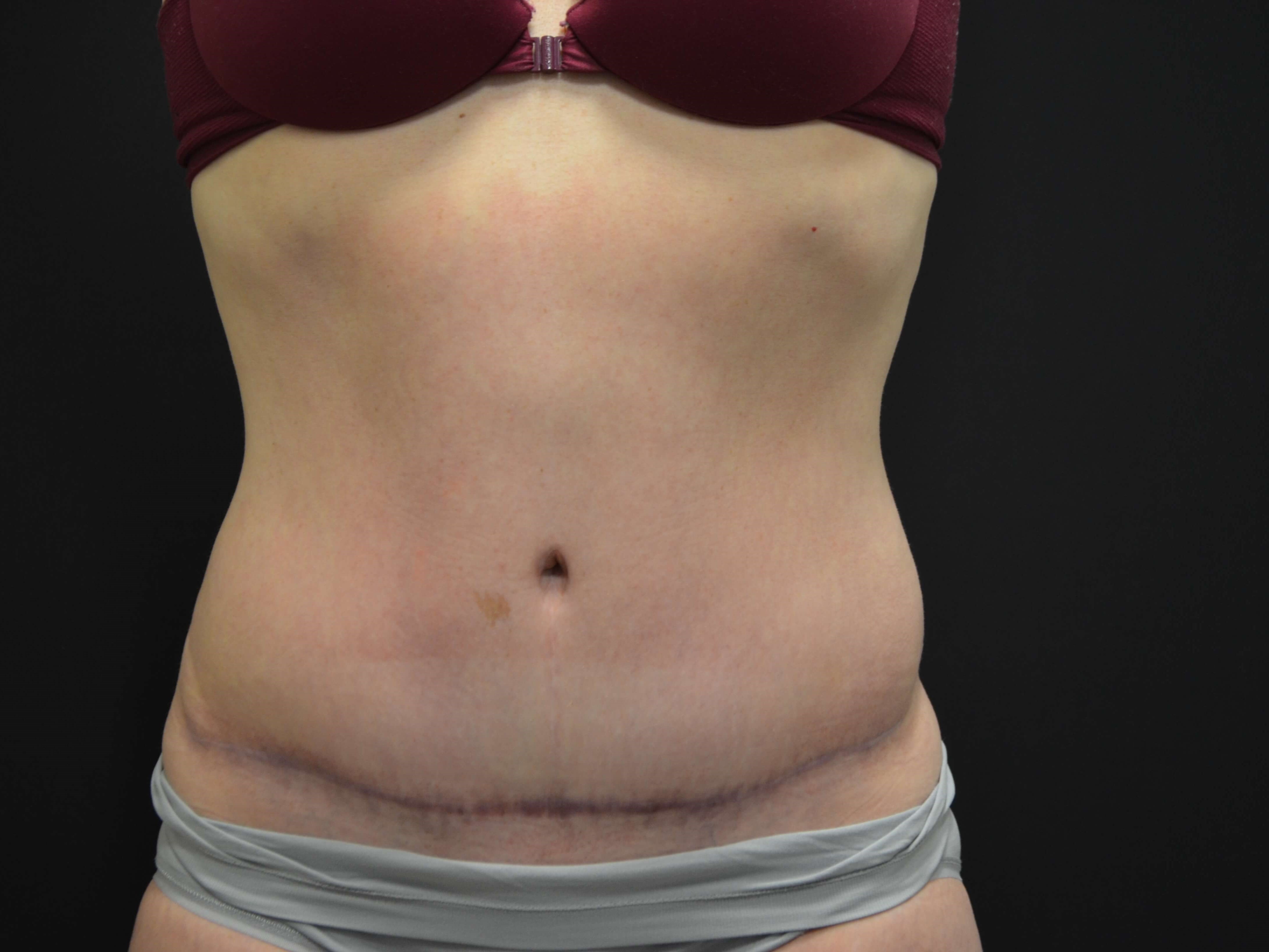 Tummy Tuck- Hinsdale, IL After