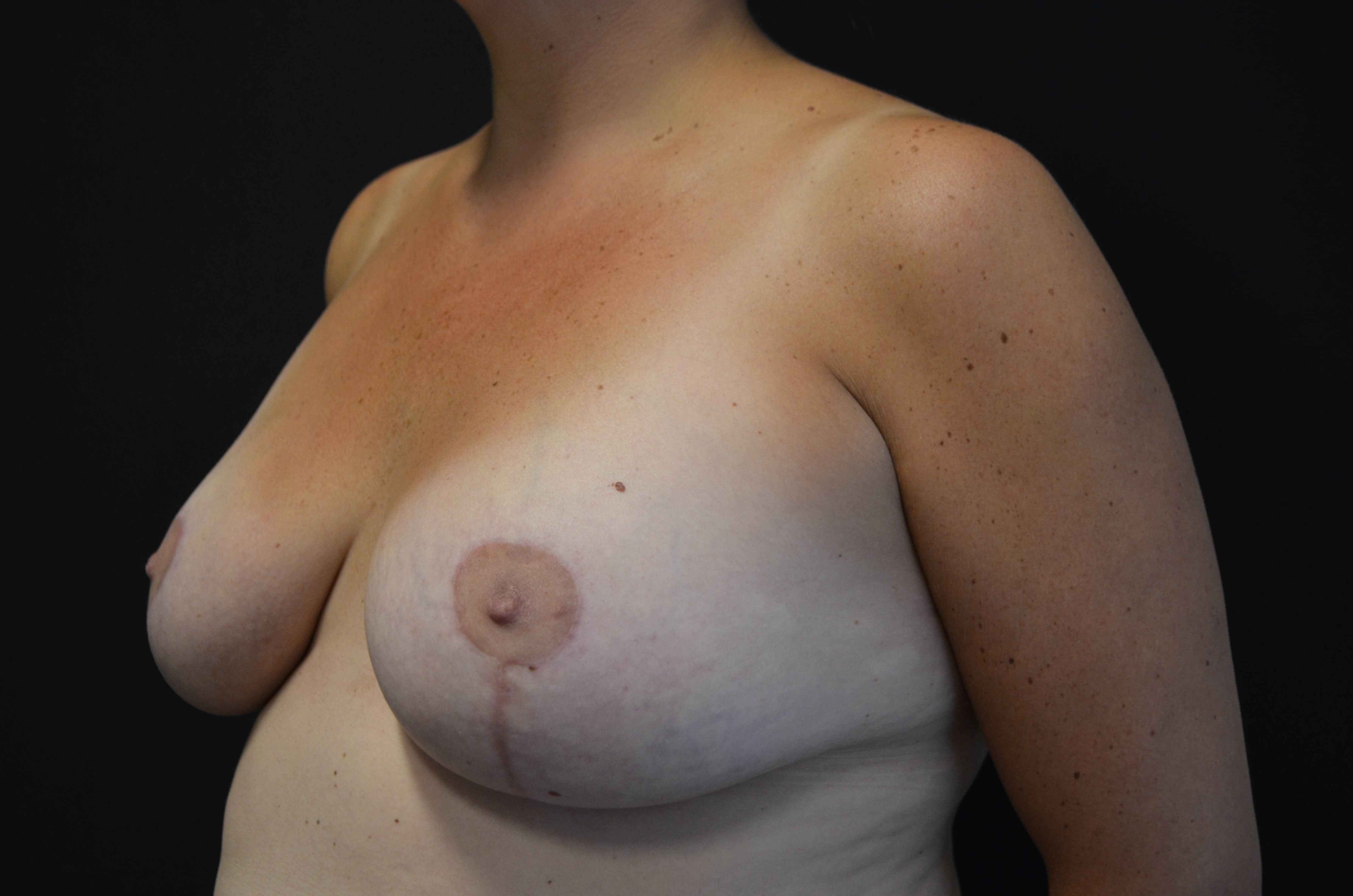 Breast Lift with Reduction After