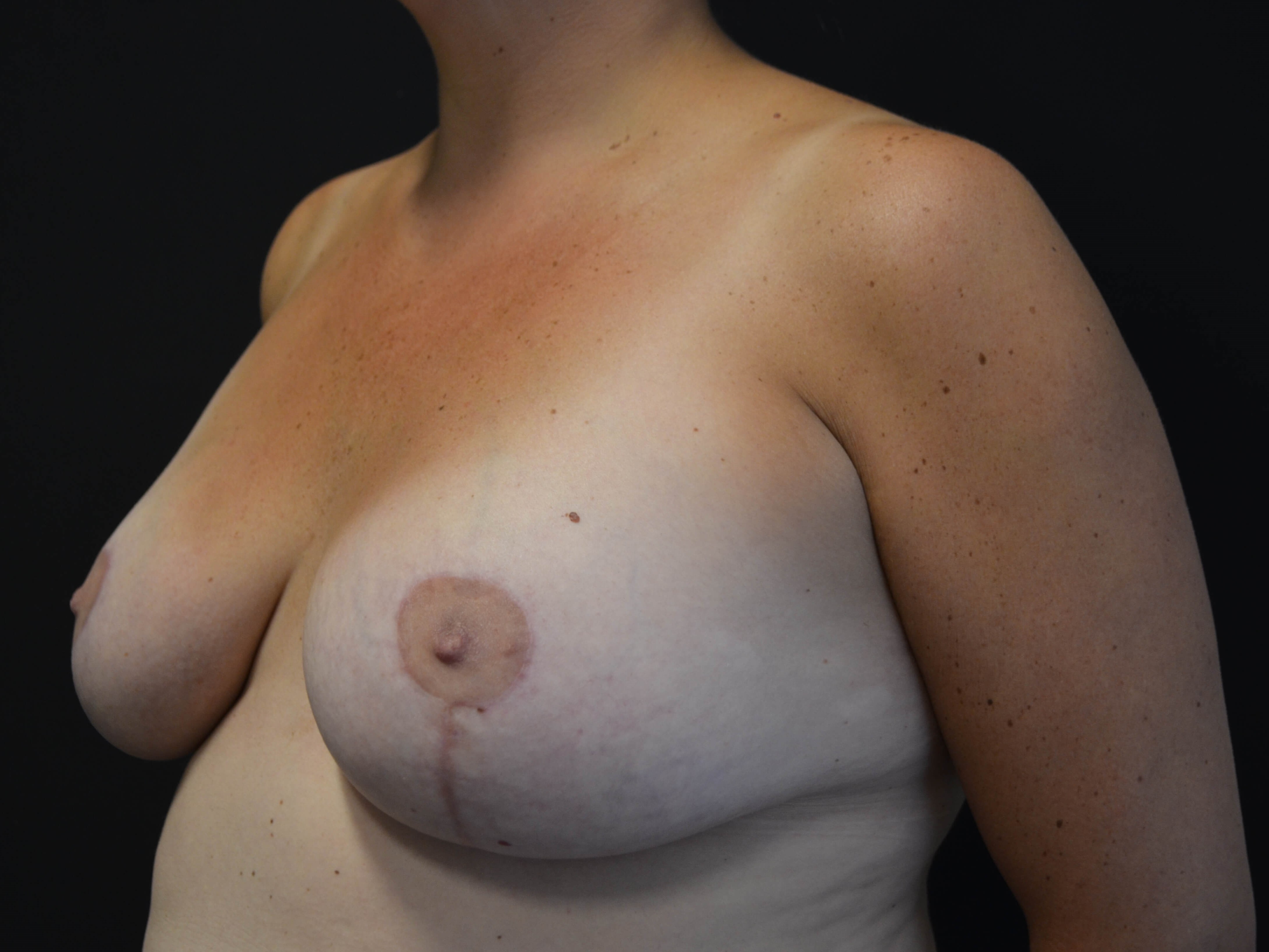 Breast Lift with Reduction After