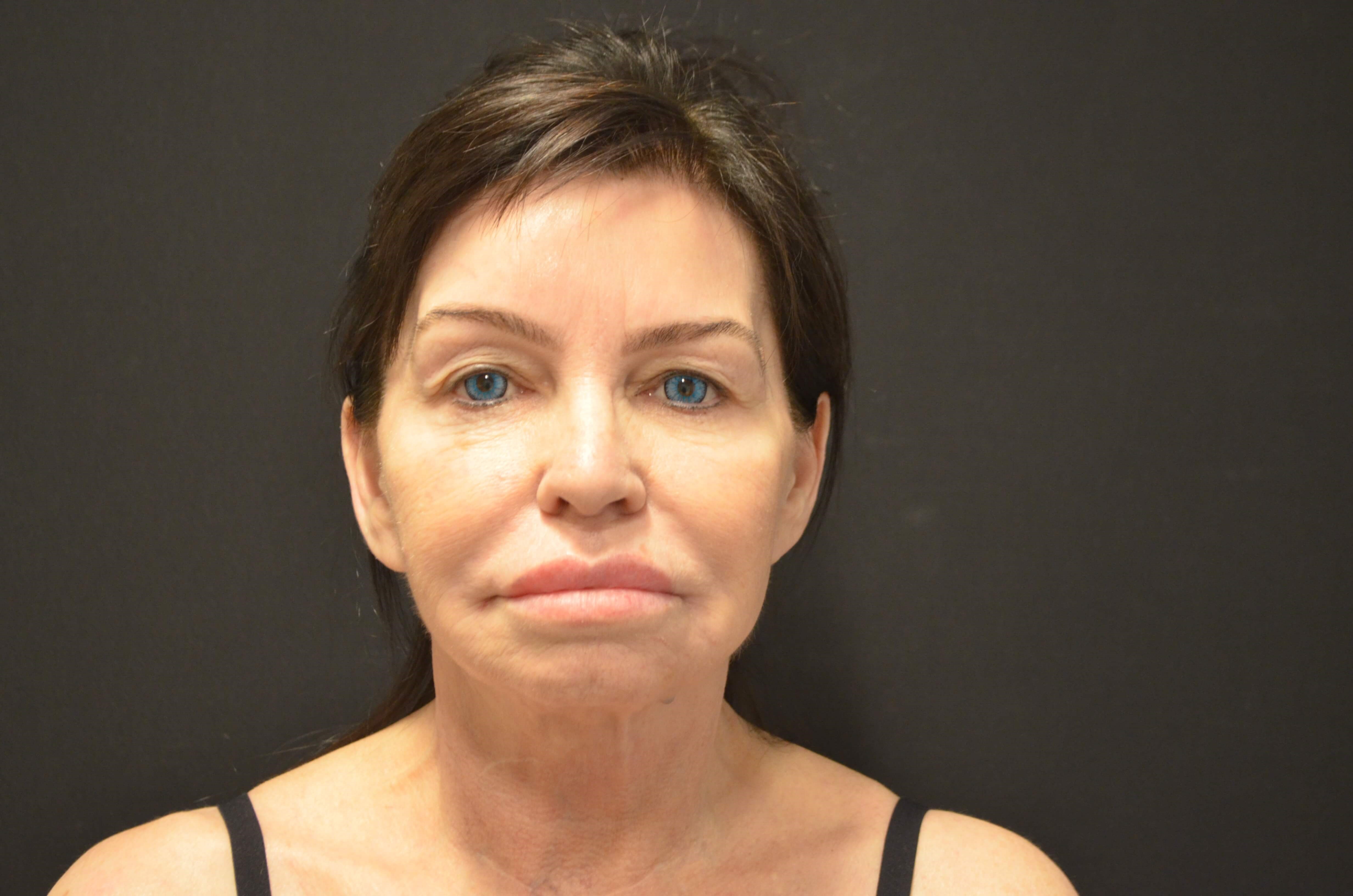 Lower Face & Neck Lift Before