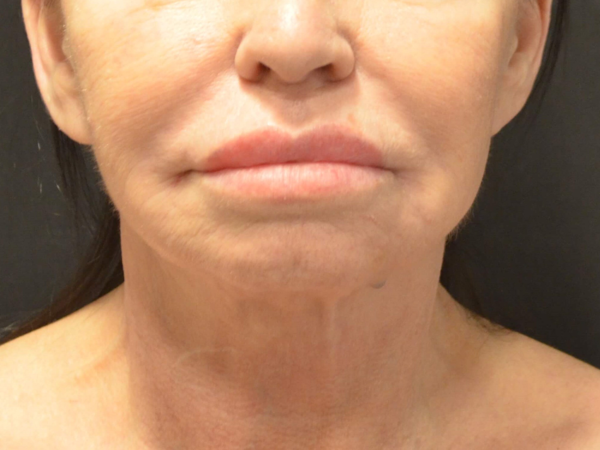 Lower Face & Neck Lift Before