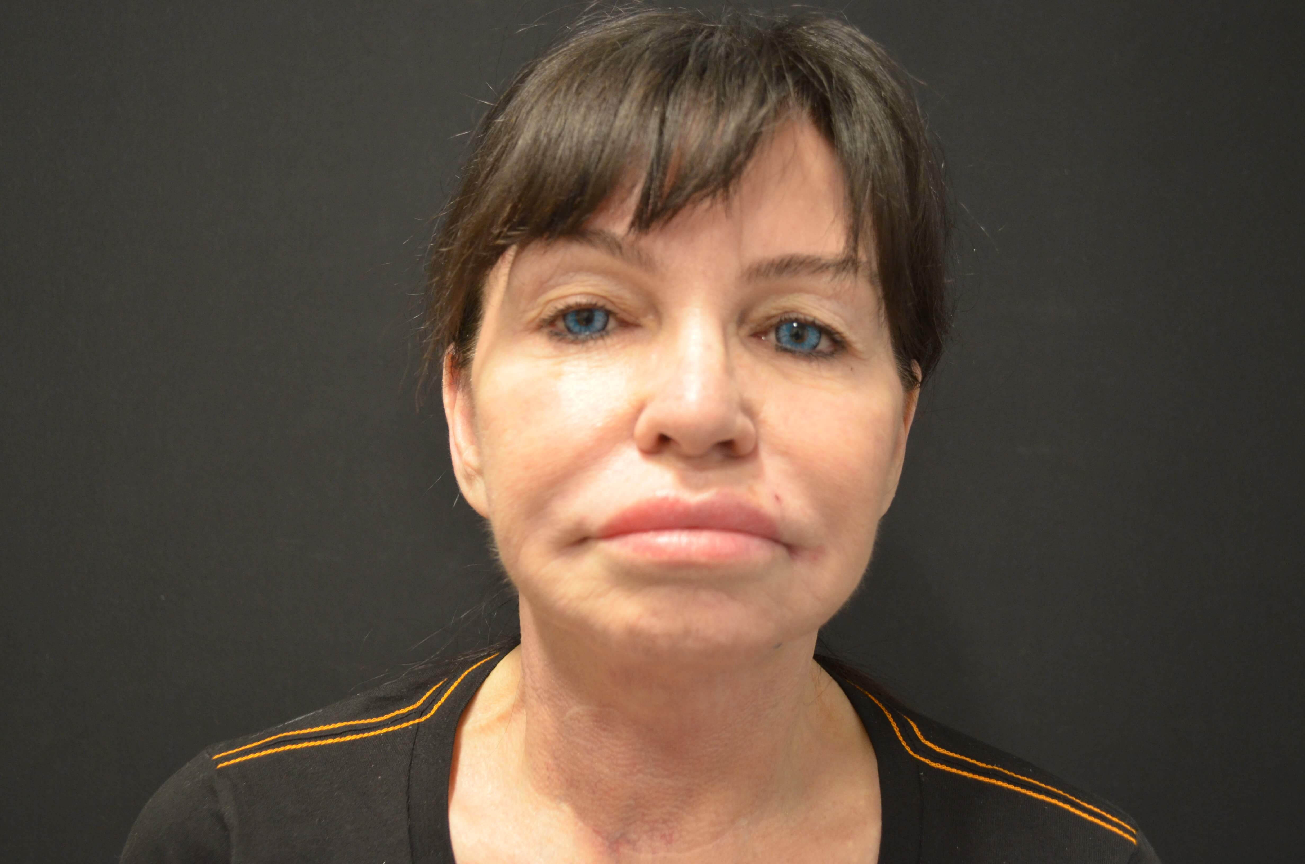 Lower Face & Neck Lift After
