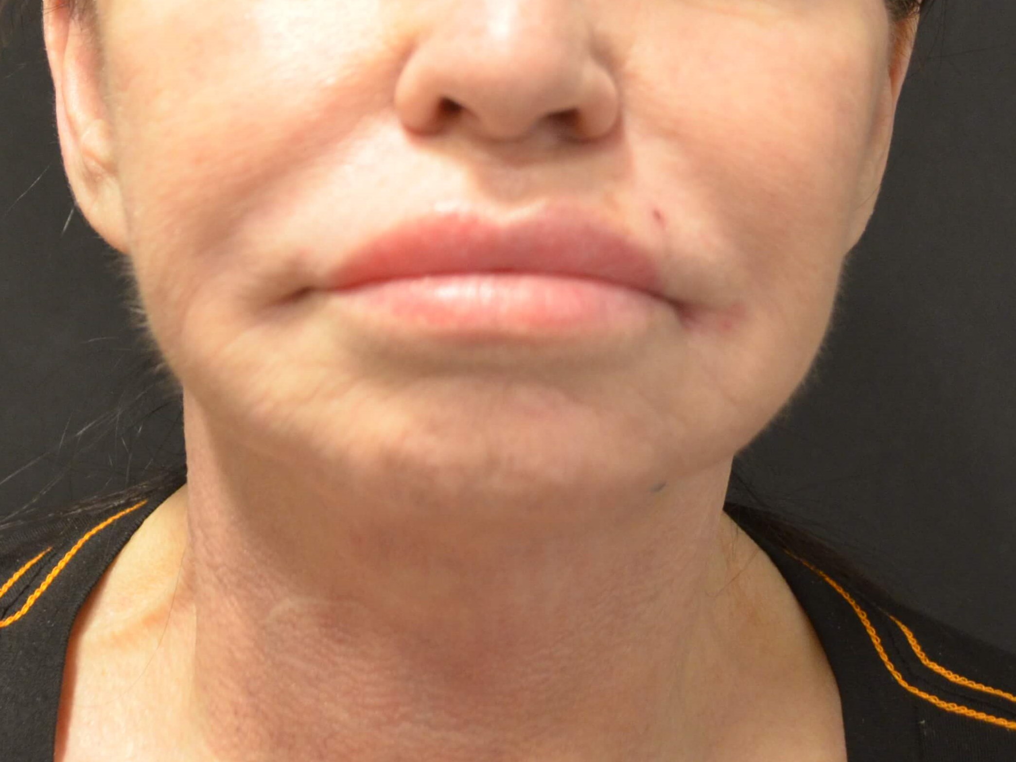 Lower Face & Neck Lift After