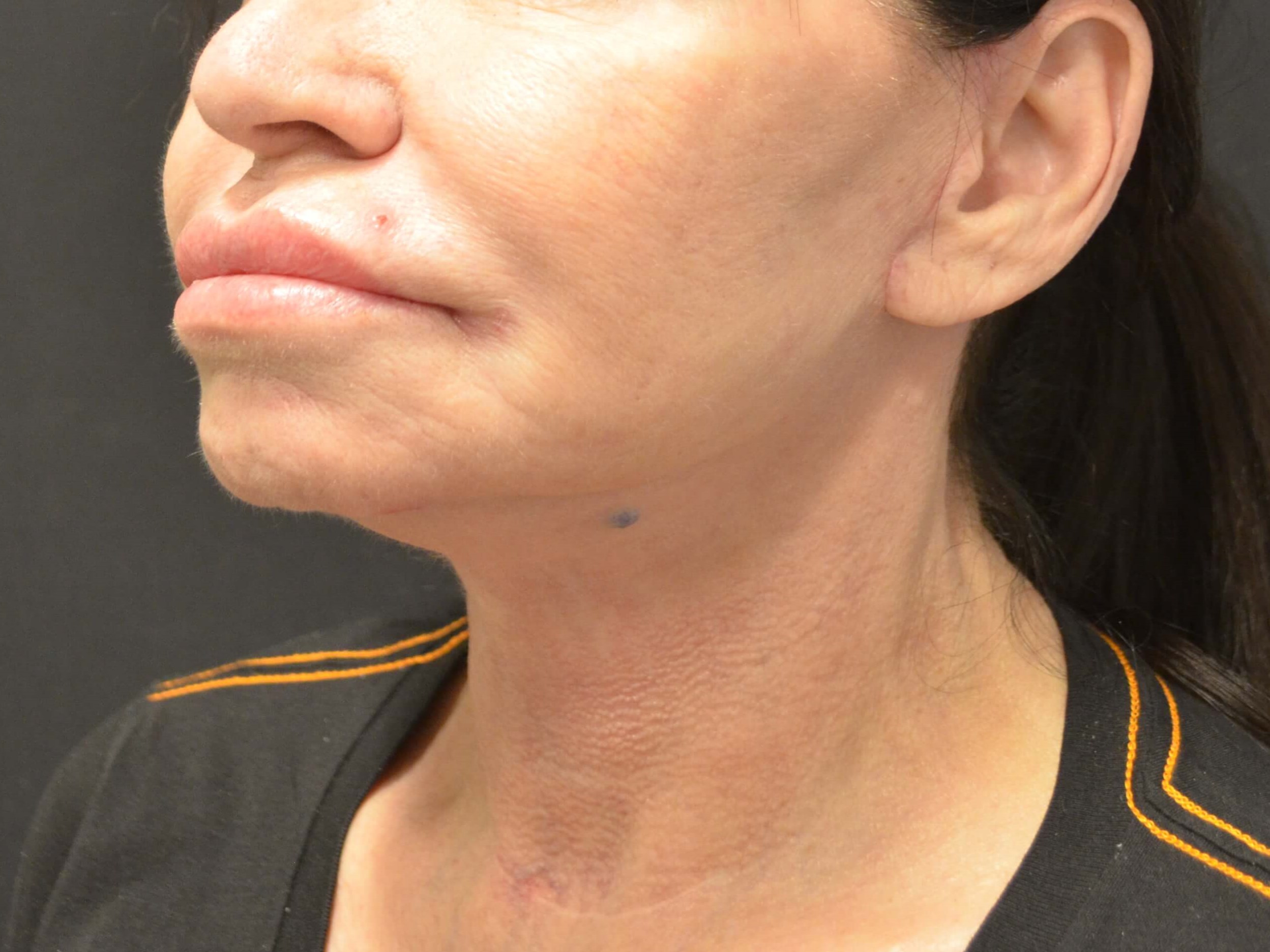 Lower Face & Neck Lift After