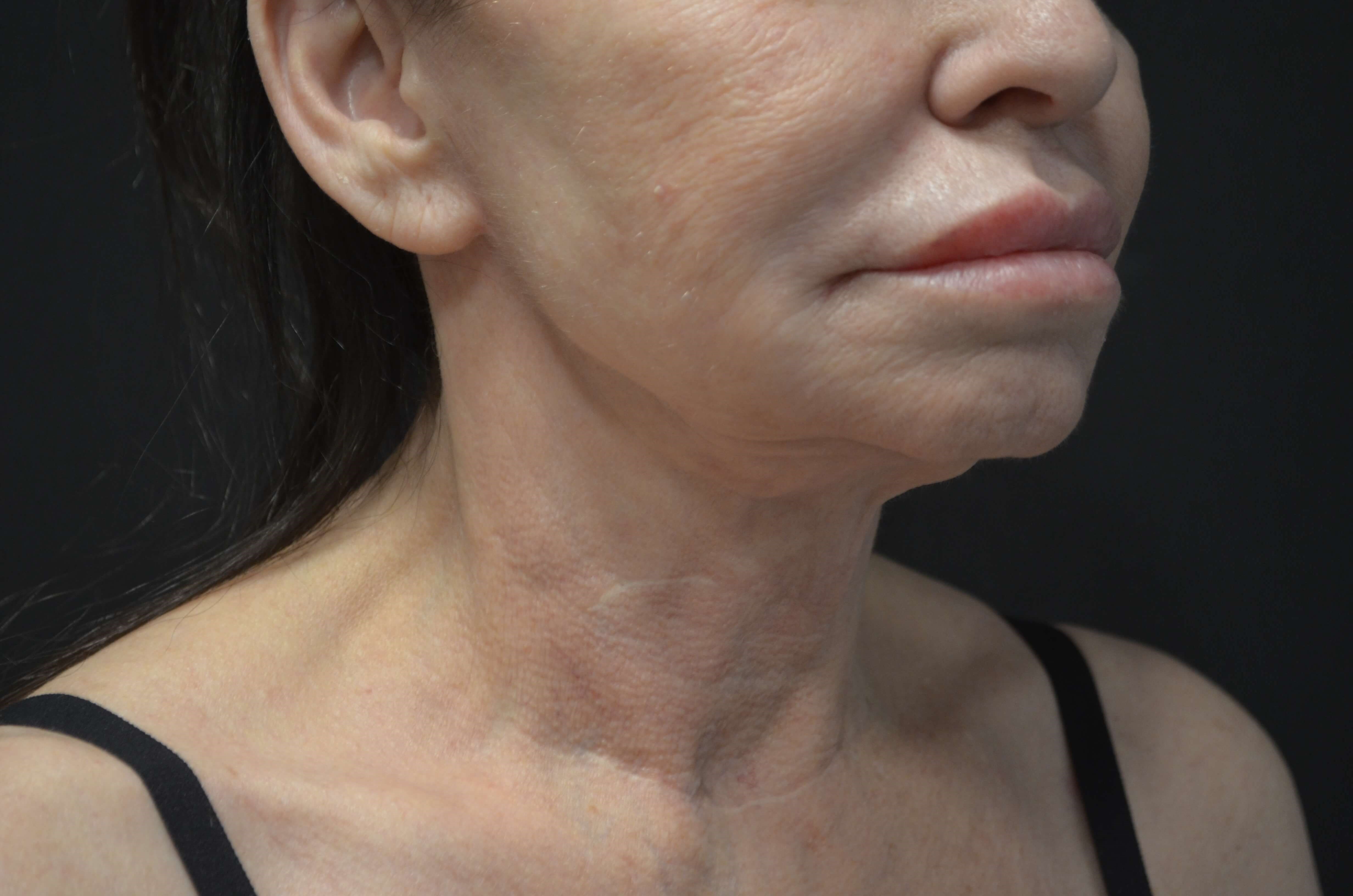 Lower Face and Neck Lift Before